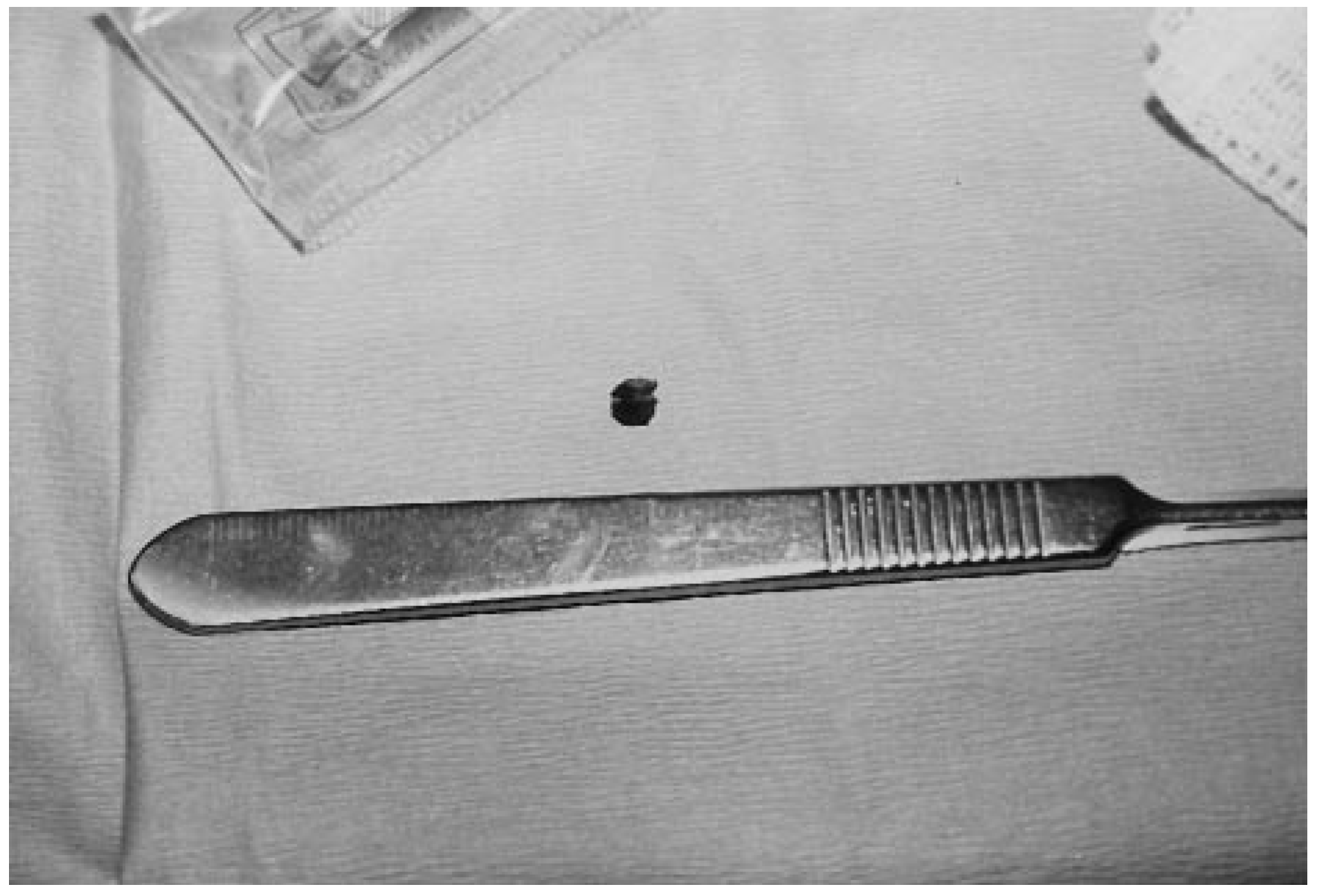 Retained Digital Foreign Body After a Pellet Gun Injury