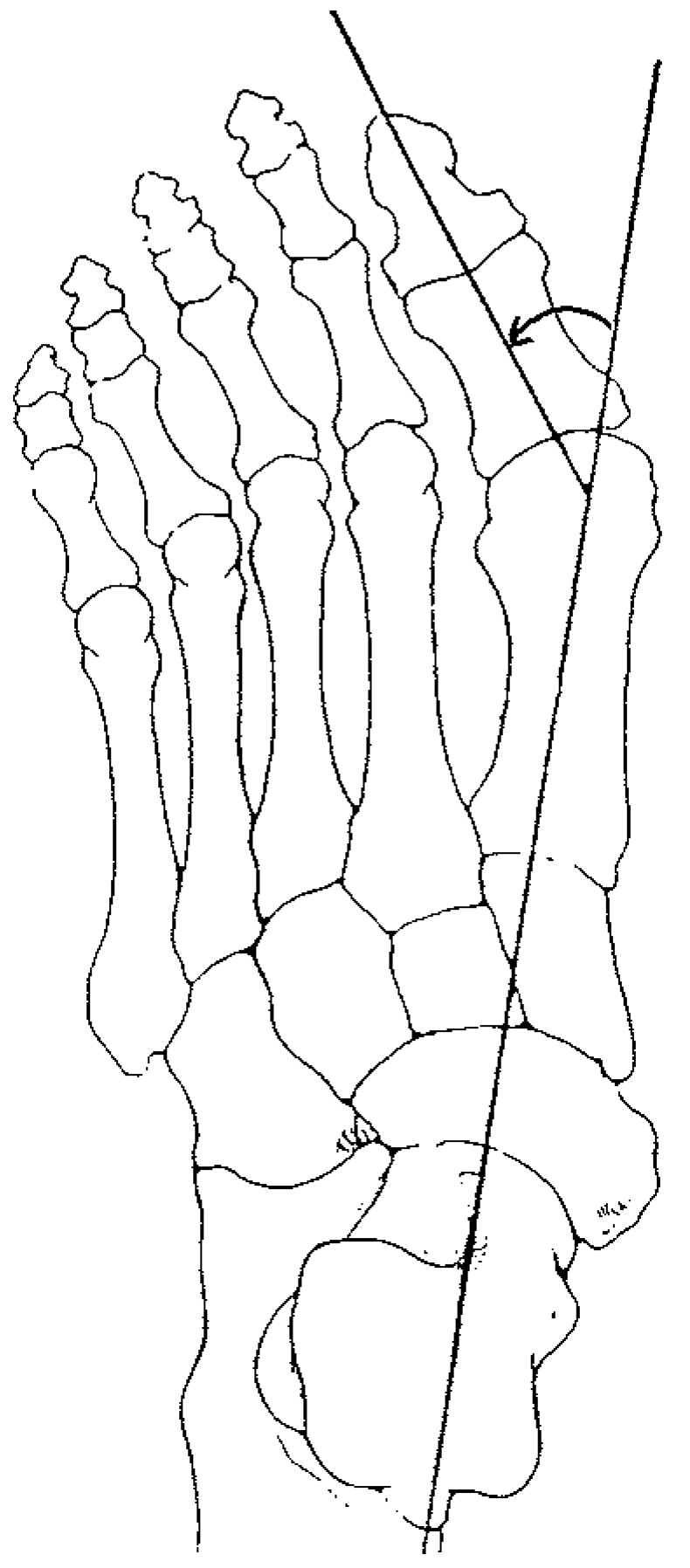 Hallux Digit The Grading of Hallux Valgus