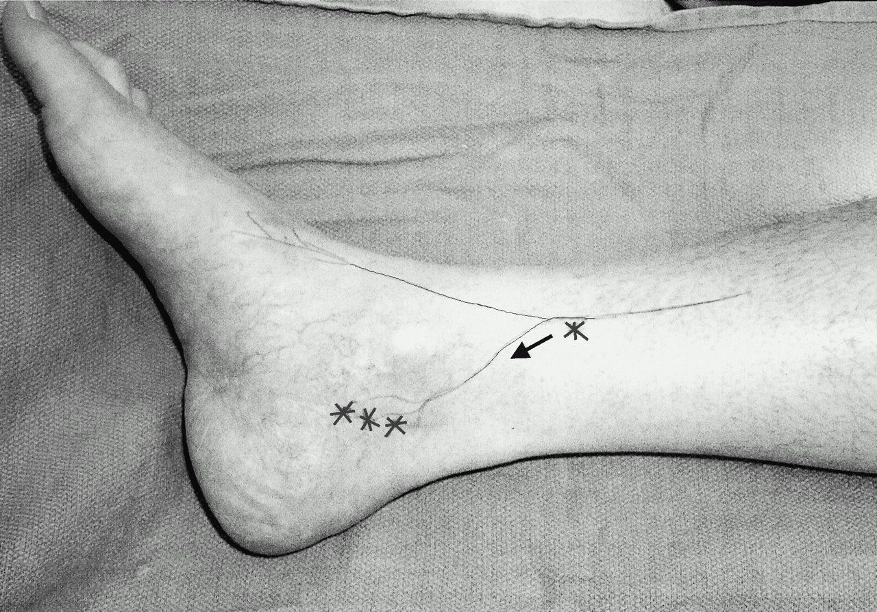 Testopel Incision Site Pain at the Site of Tarsal Tunnel Incision Due to Neuroma of the ...