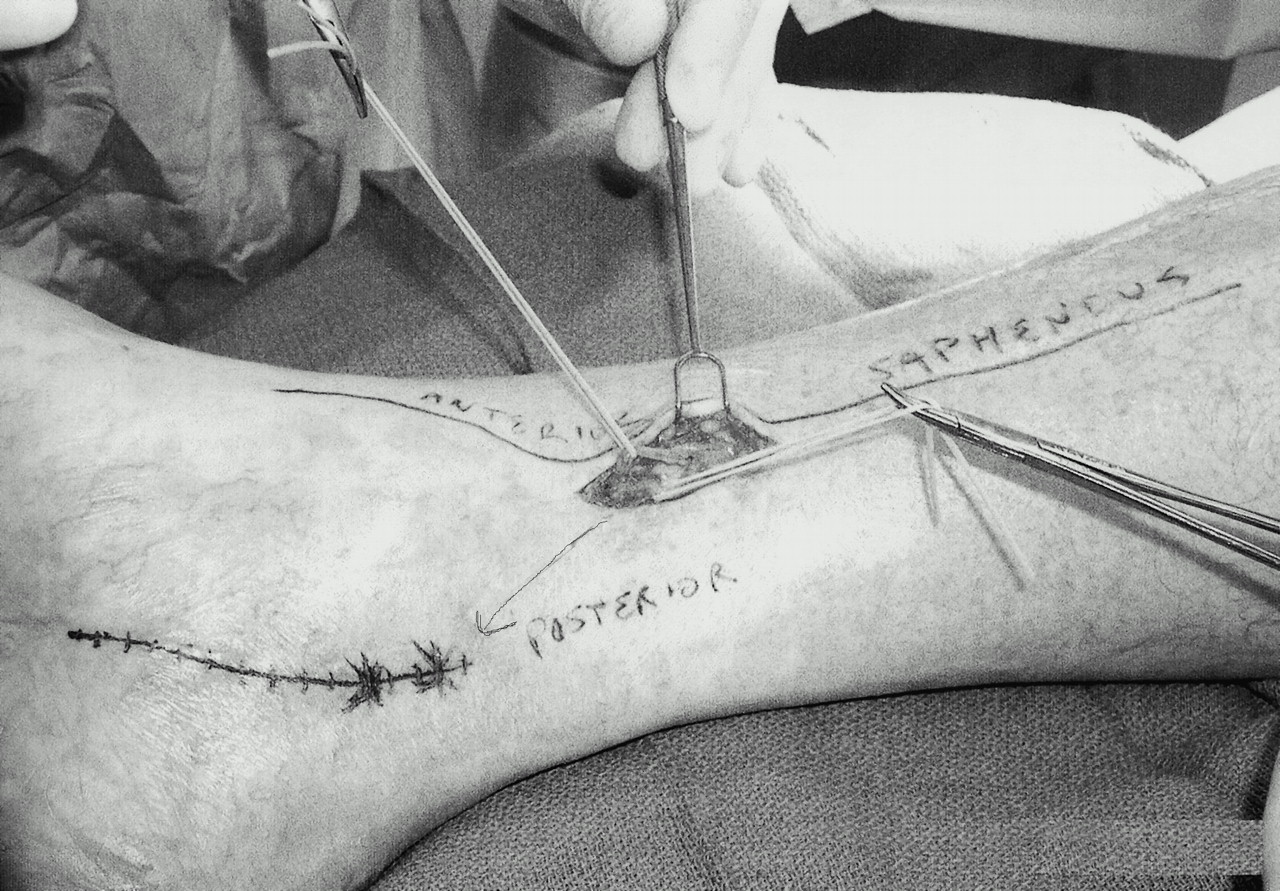 Testopel Incision Site Pain at the Site of Tarsal Tunnel Incision Due to Neuroma of the ...