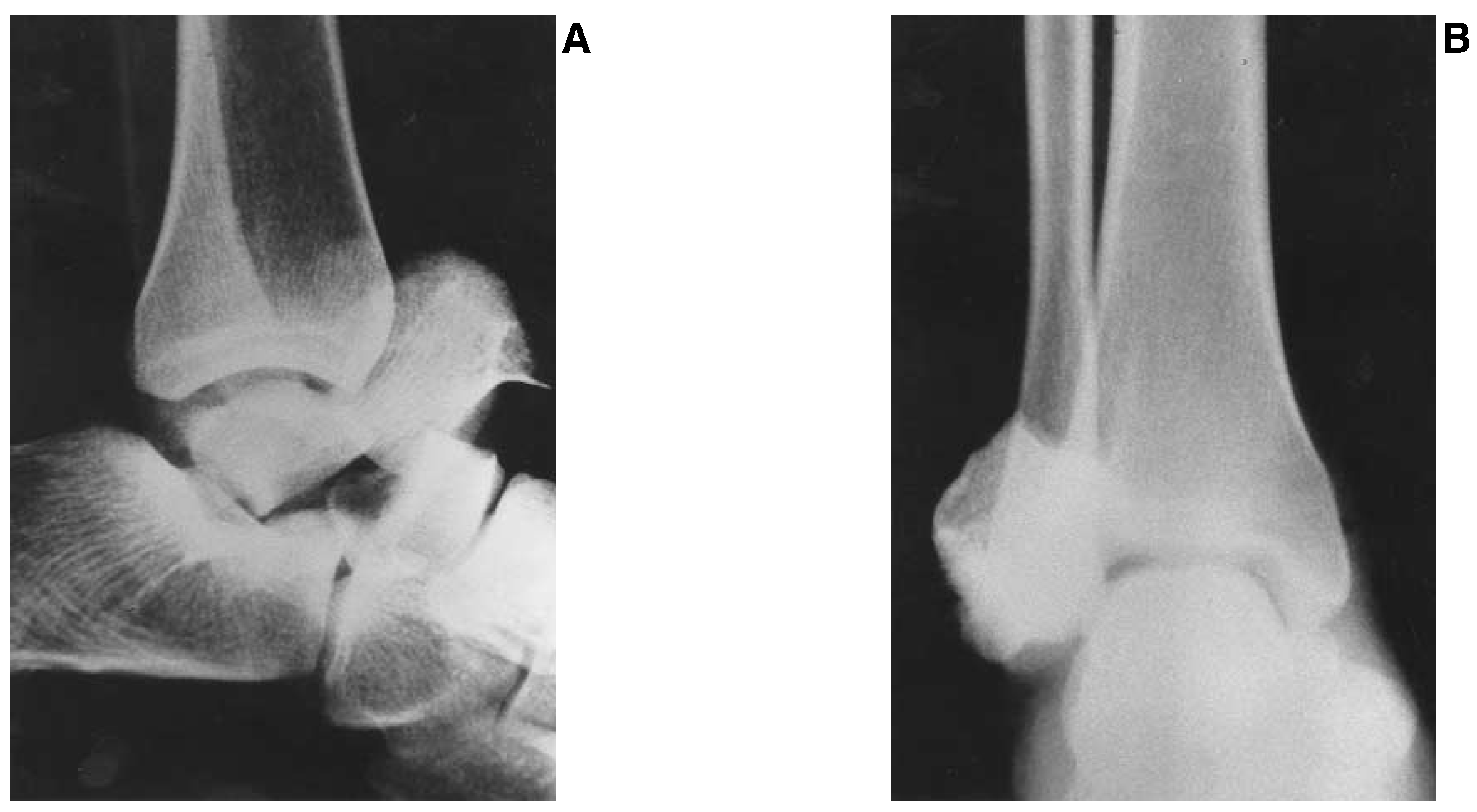 Talar Fractures. Three Case Studies