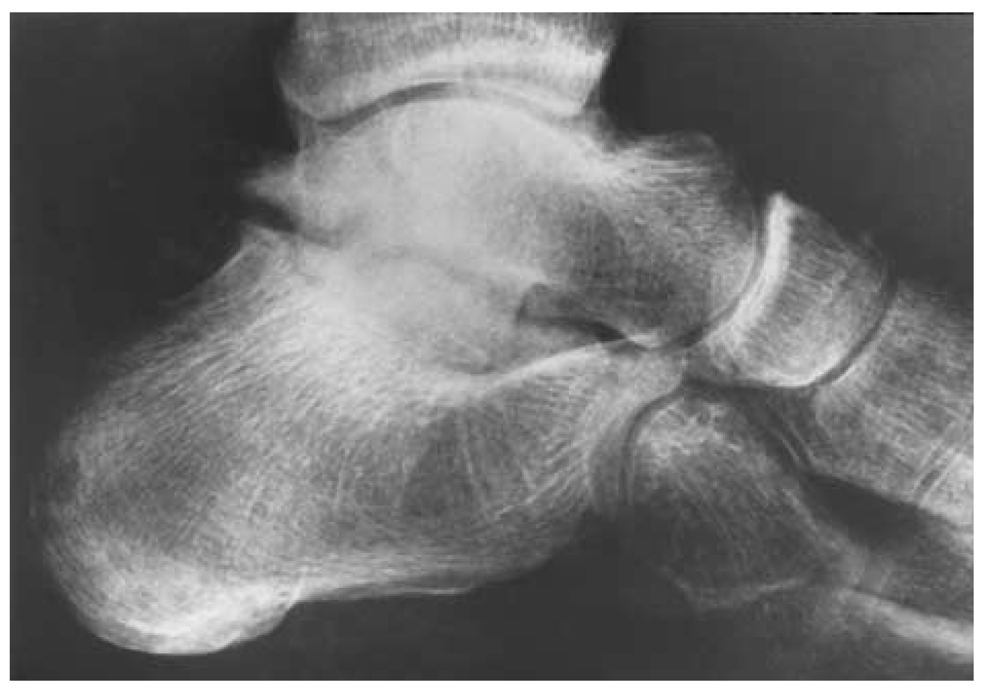Talar Talar Fractures. Three Case Studies