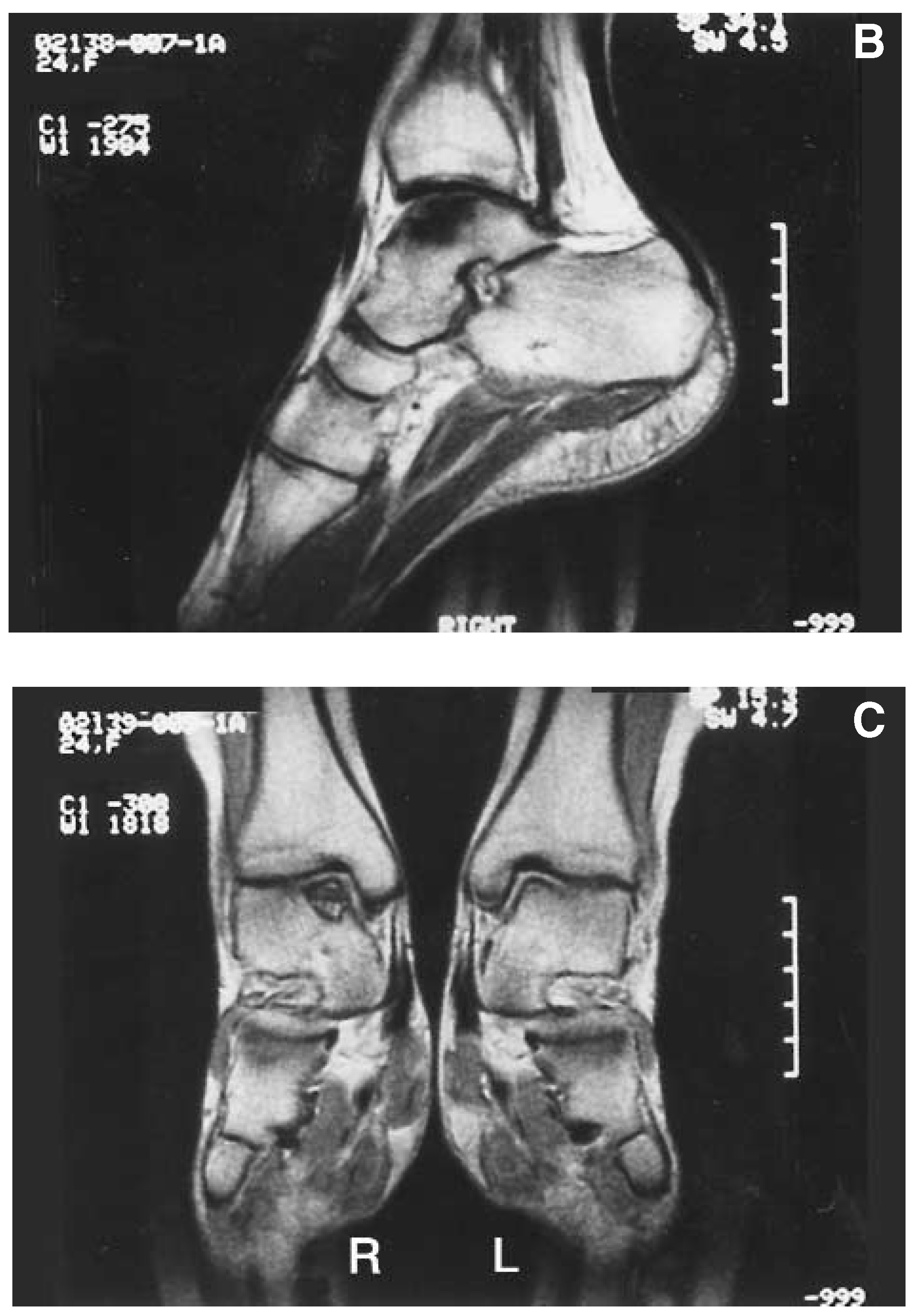 Talar Fractures. Three Case Studies