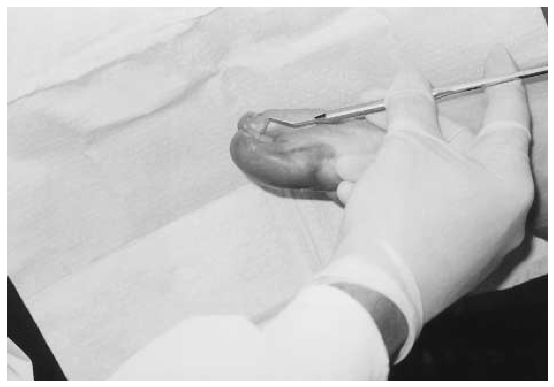 Mozena Classification The Mozena Classification System and Treatment Algorithm for Ingrown ...