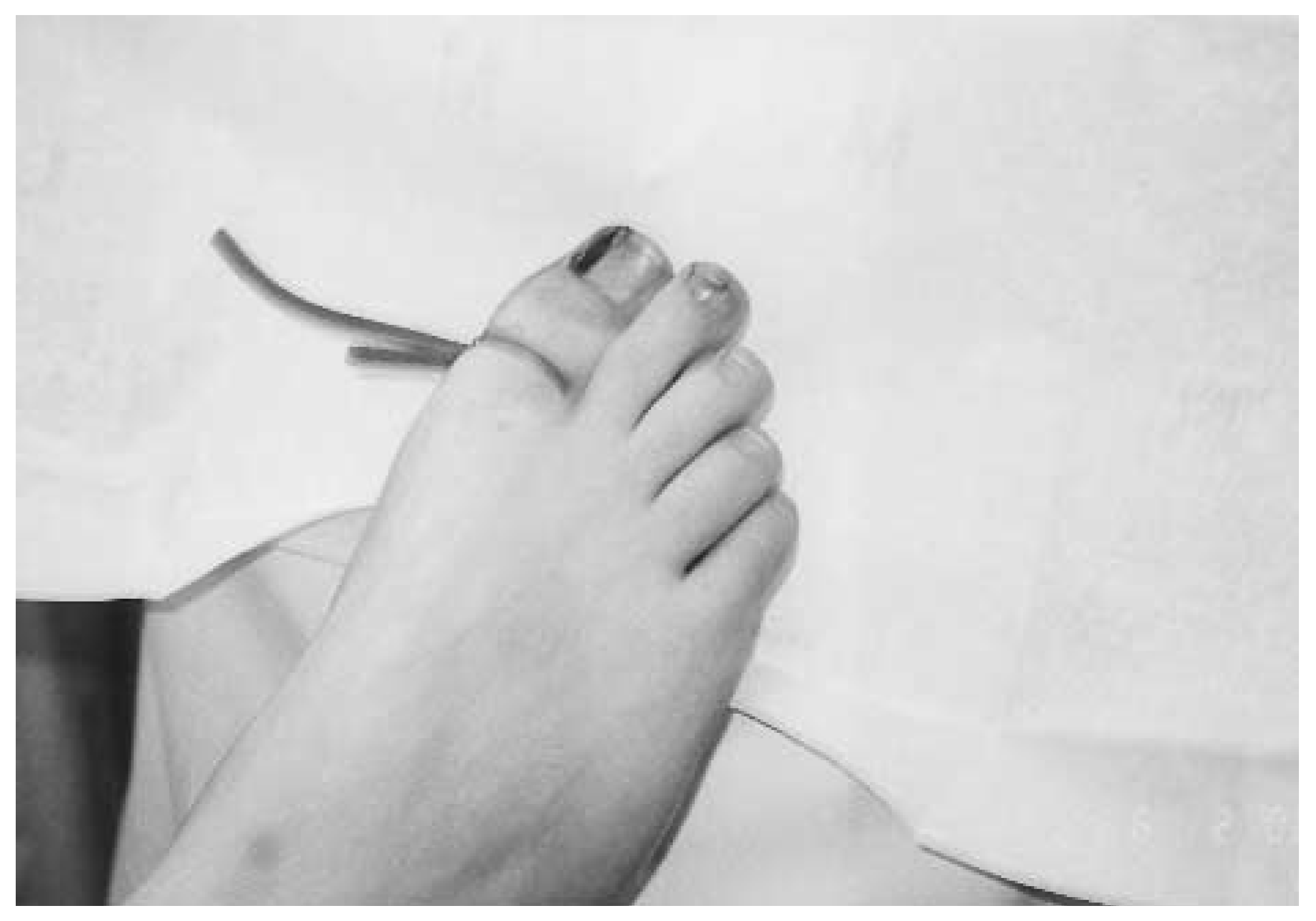 Mozena Classification The Mozena Classification System and Treatment Algorithm for Ingrown ...