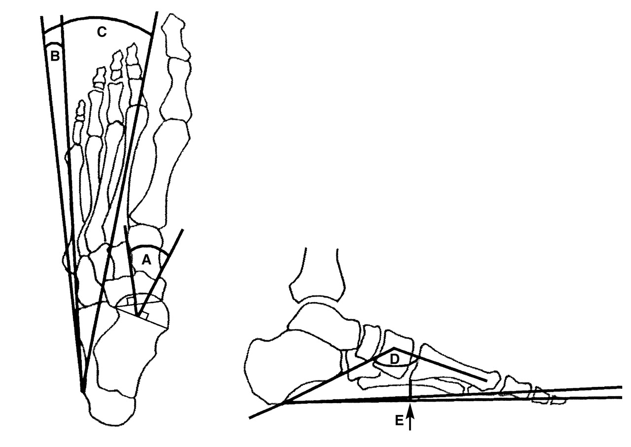 Frame Foot Check Classification Criterion Validation of Four Criteria of the Foot Posture Index