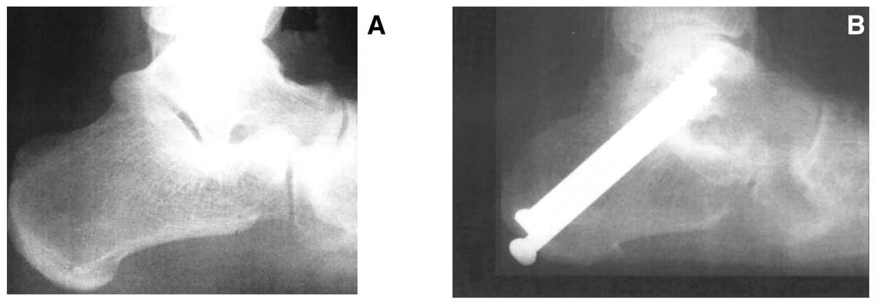 Subtalar Joint Arthrodesis