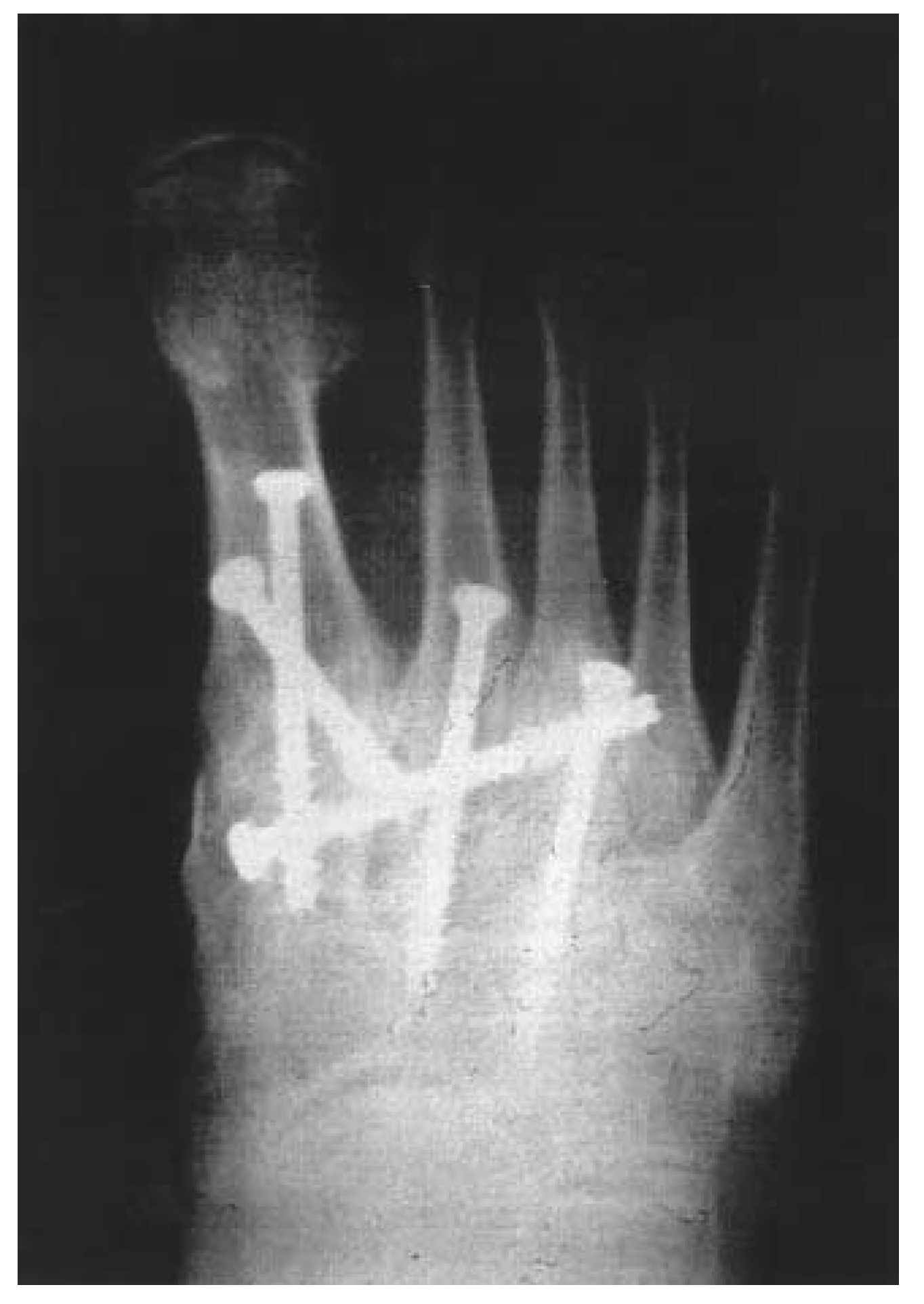 Tmt Joint Injection Technical Considerations in Tarsometatarsal Joint Arthrodesis
