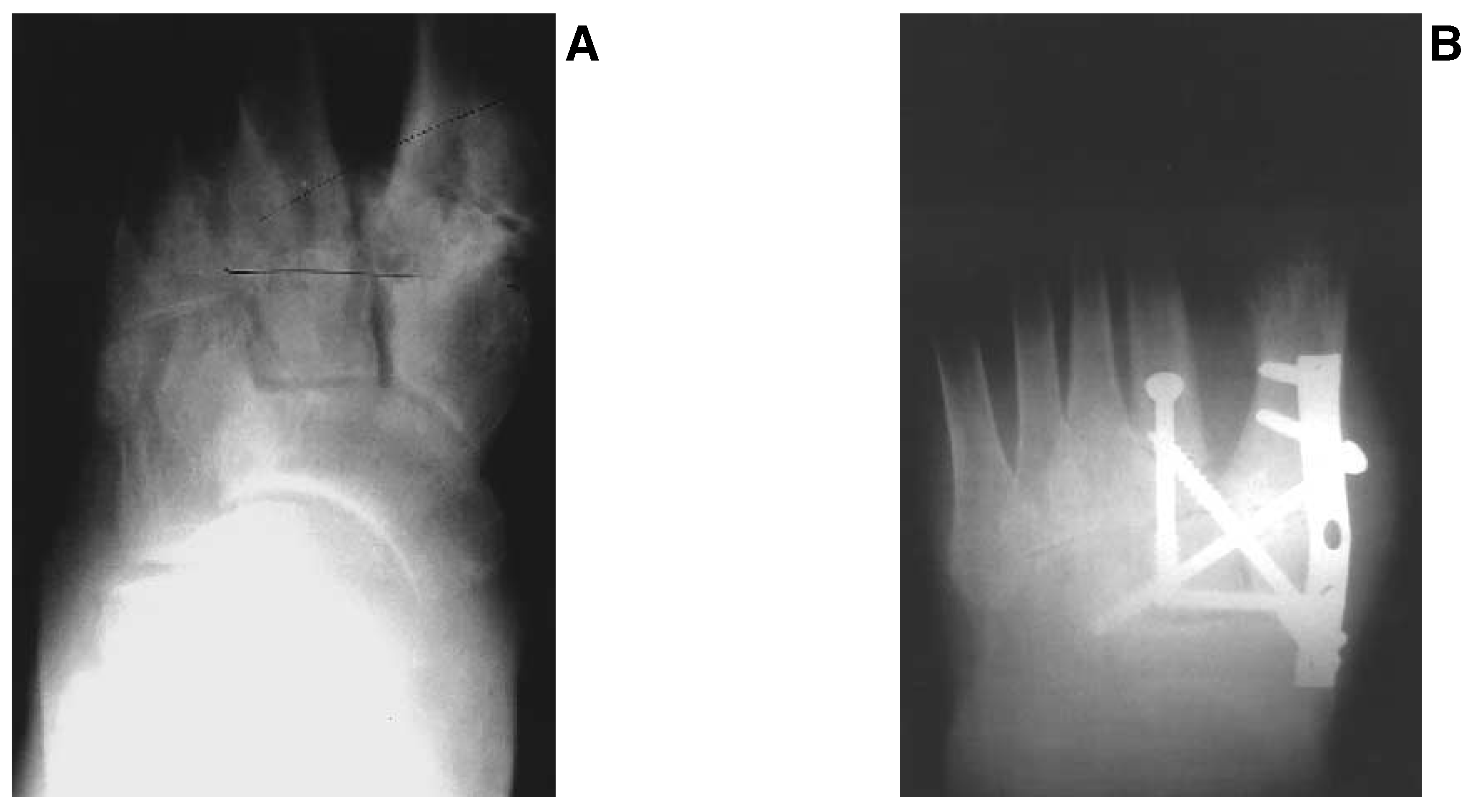 Tmt Joint Injection Technical Considerations in Tarsometatarsal Joint Arthrodesis