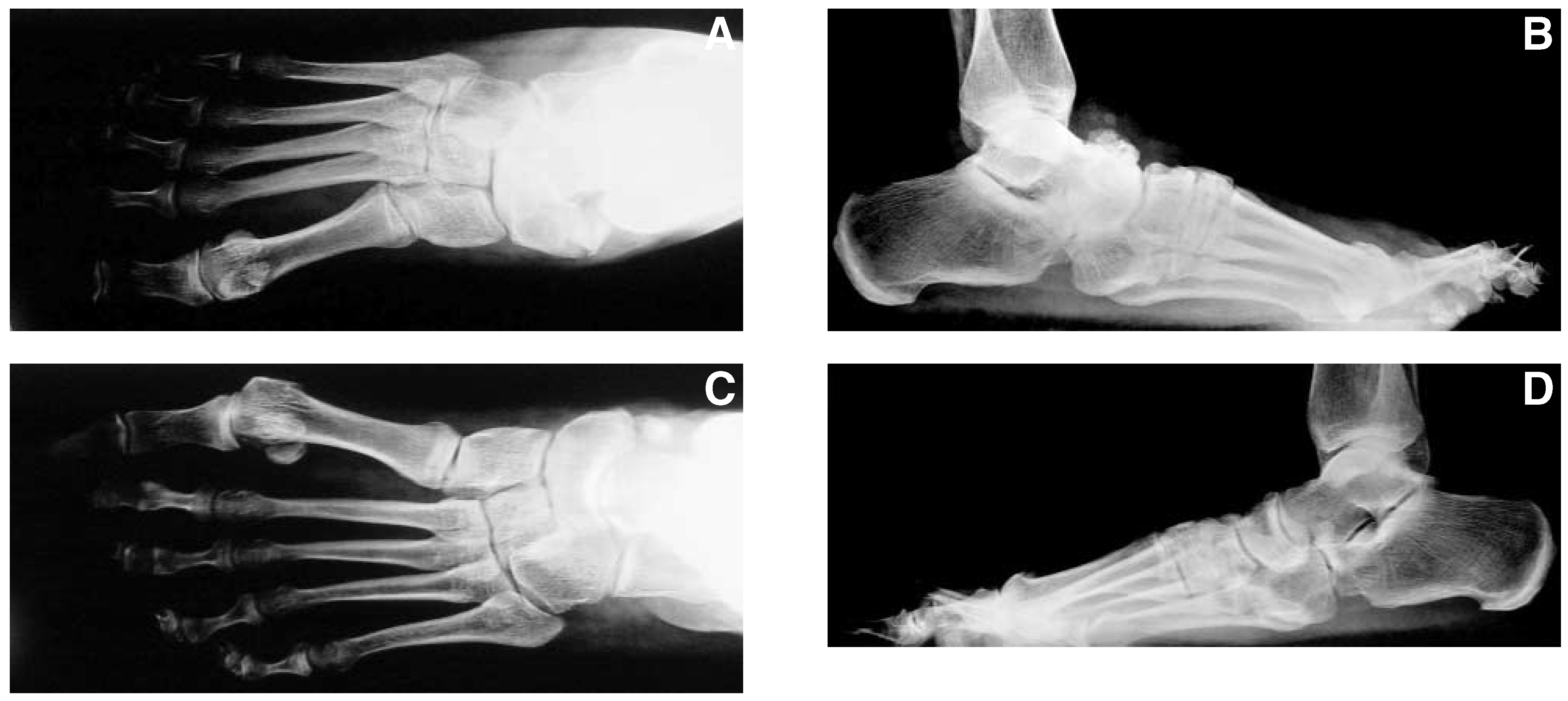 Sepsis Rash Foot Spontaneous Bilateral Ankle and Midfoot Sepsis in a ...