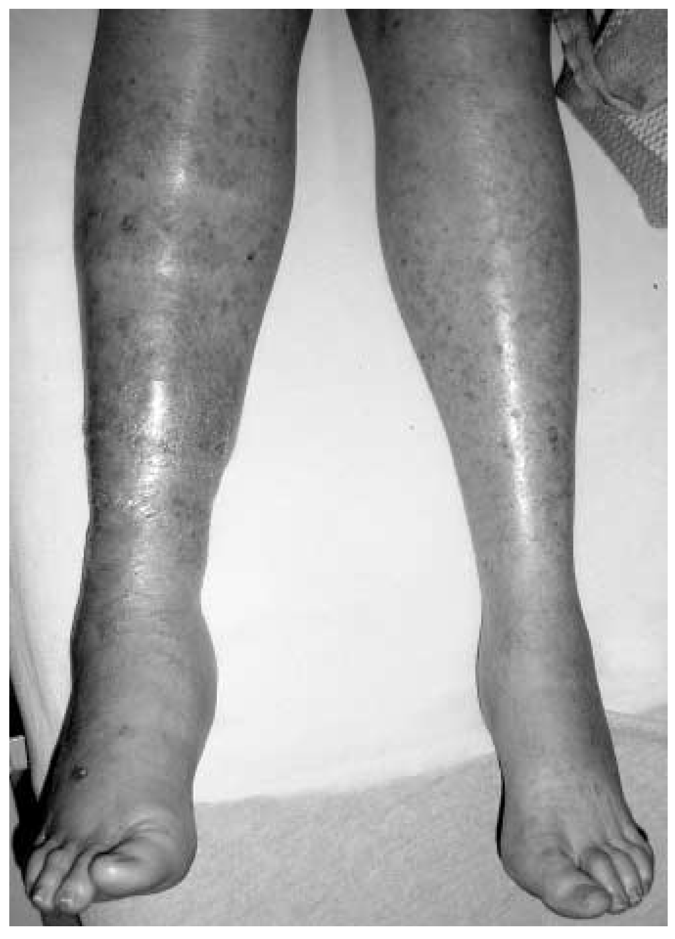 Sepsis Rash Foot Spontaneous Bilateral Ankle and Midfoot Sepsis in a ...