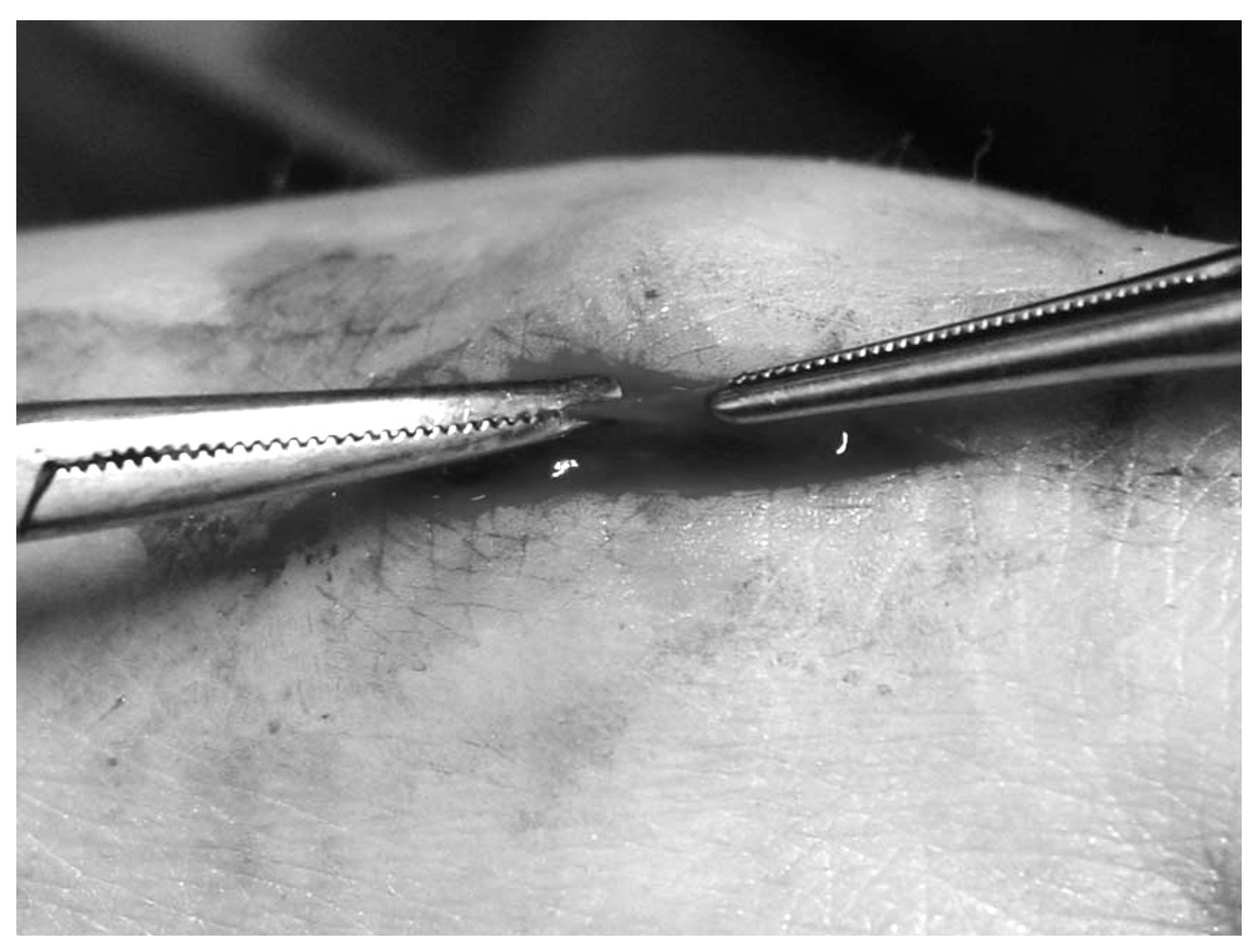 A Previously Unreported Etiology of Trigger Toe