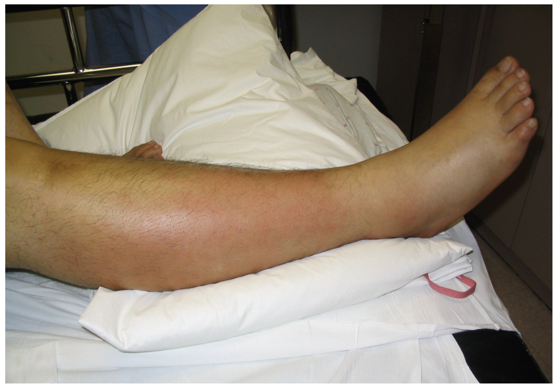 Traumatic Rhabdo Exercise-Induced Rhabdomyolysis