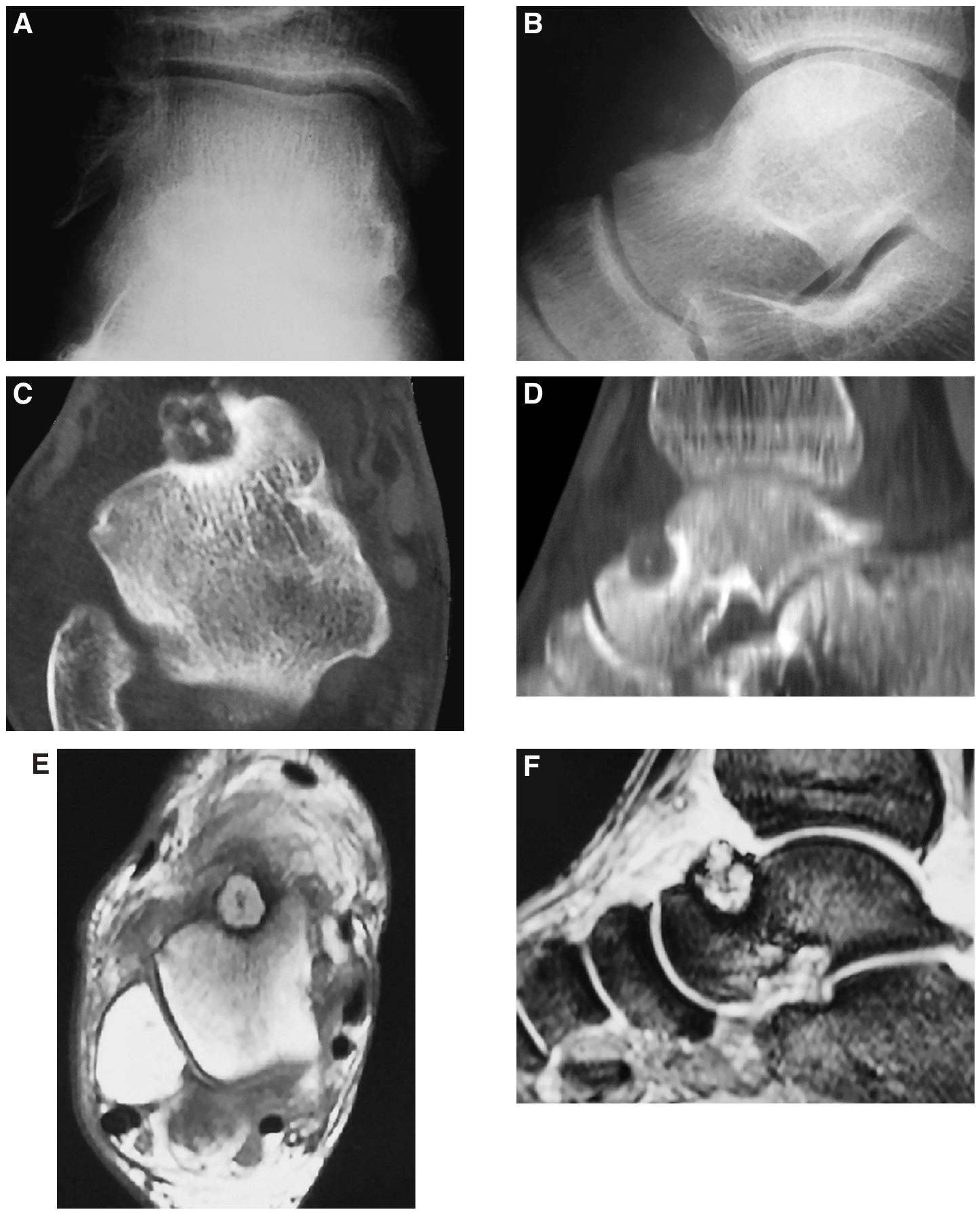 Arthroscopic Removal of a Subperiosteal Osteoid Osteoma of the Talus
