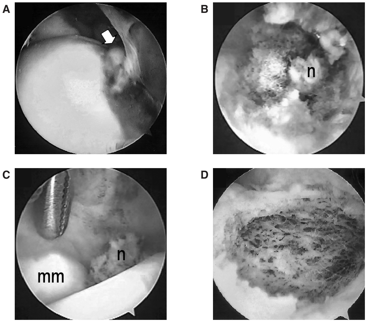 Arthroscopic Removal of a Subperiosteal Osteoid Osteoma of the Talus
