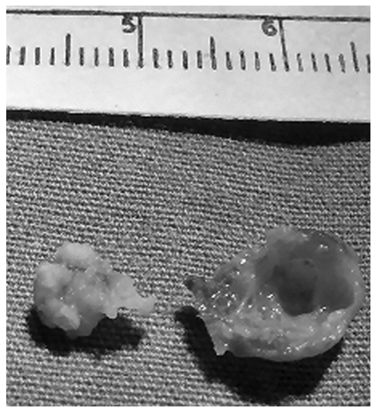 Arthroscopic Removal of a Subperiosteal Osteoid Osteoma of the Talus