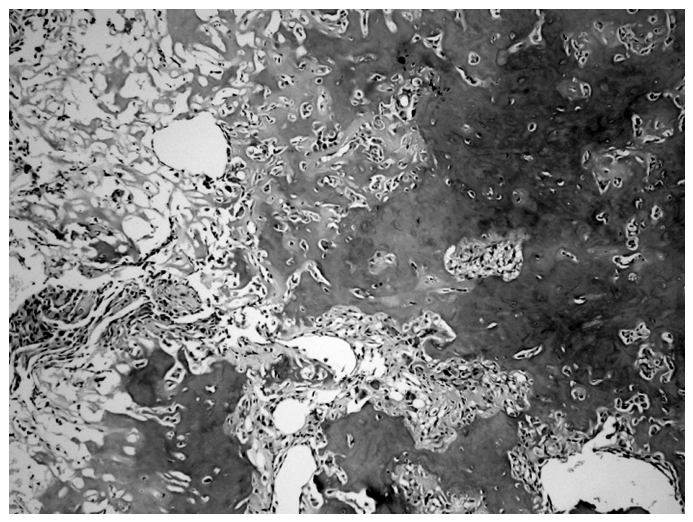 Arthroscopic Removal of a Subperiosteal Osteoid Osteoma of the Talus