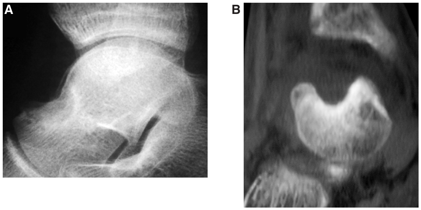 Arthroscopic Removal of a Subperiosteal Osteoid Osteoma of the Talus