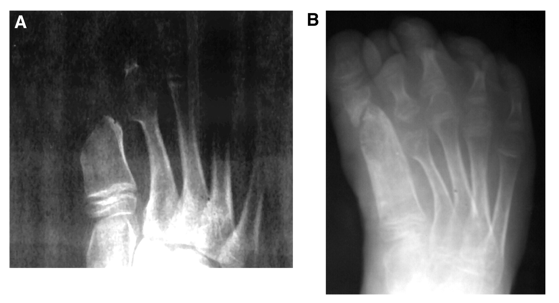 First Metatarsal Callus Distraction