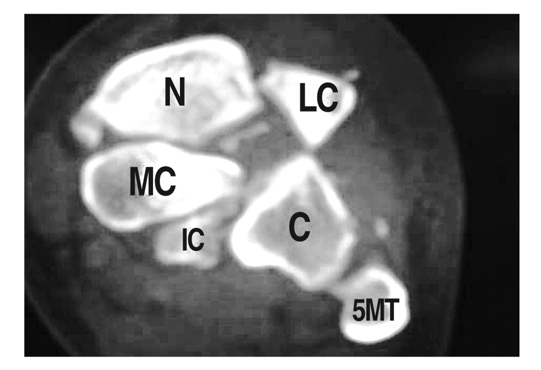 A Complex Variant of Lisfranc Joint Complex Injury