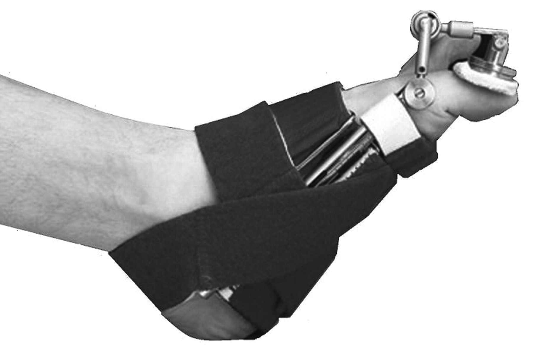 Dynamic Splinting for Runner’s Toe. A Case Report with Gait Analysis