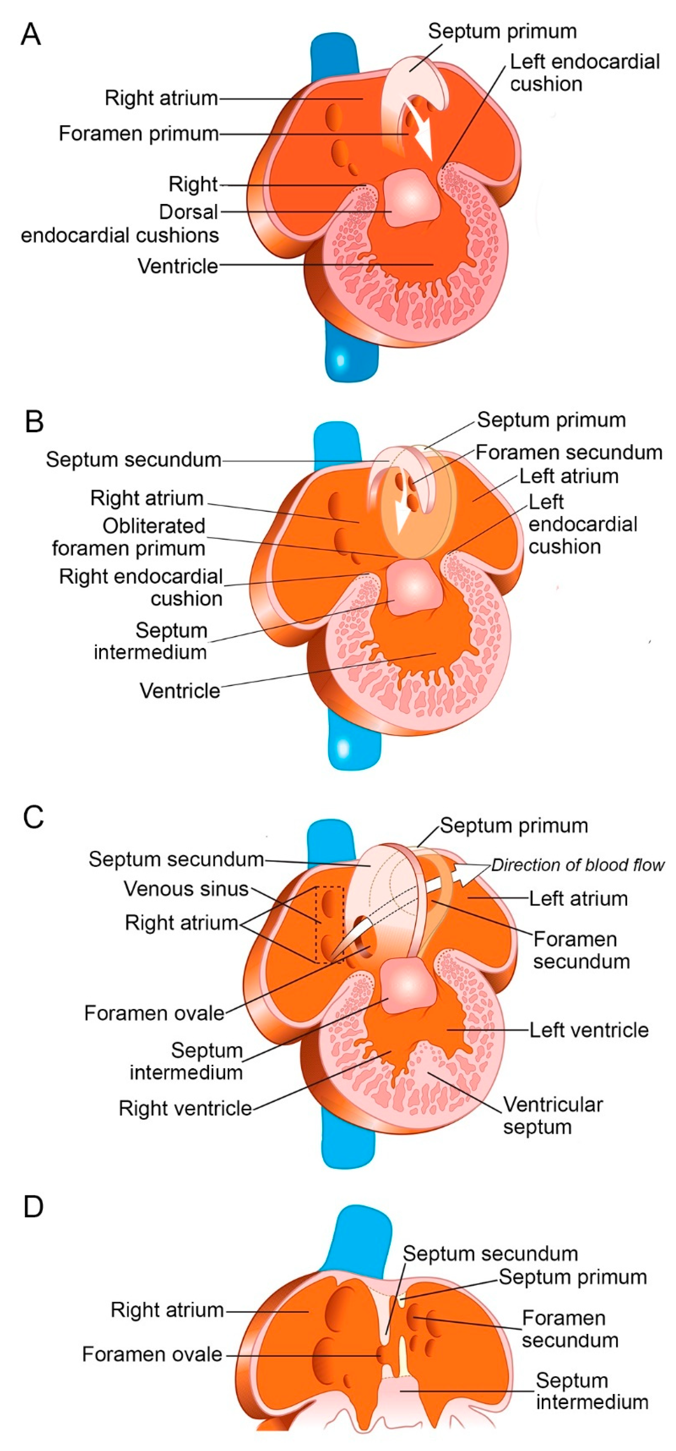 Patent Foramen Ovale (PFO): Symptoms, Causes & Treatment