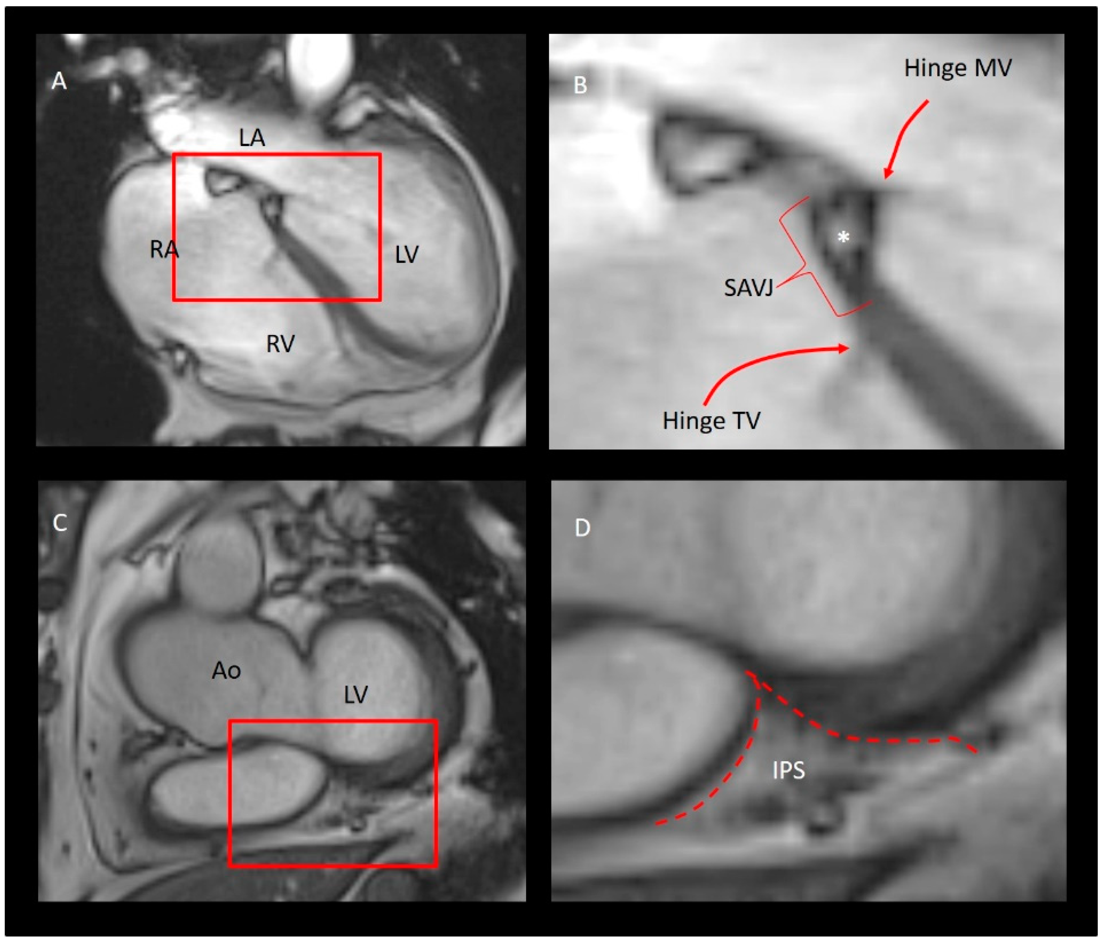 Multi-Modality Imaging of the Tricuspid Valve: From Tricuspid Valve Disease  to Catheter-Based Interventions