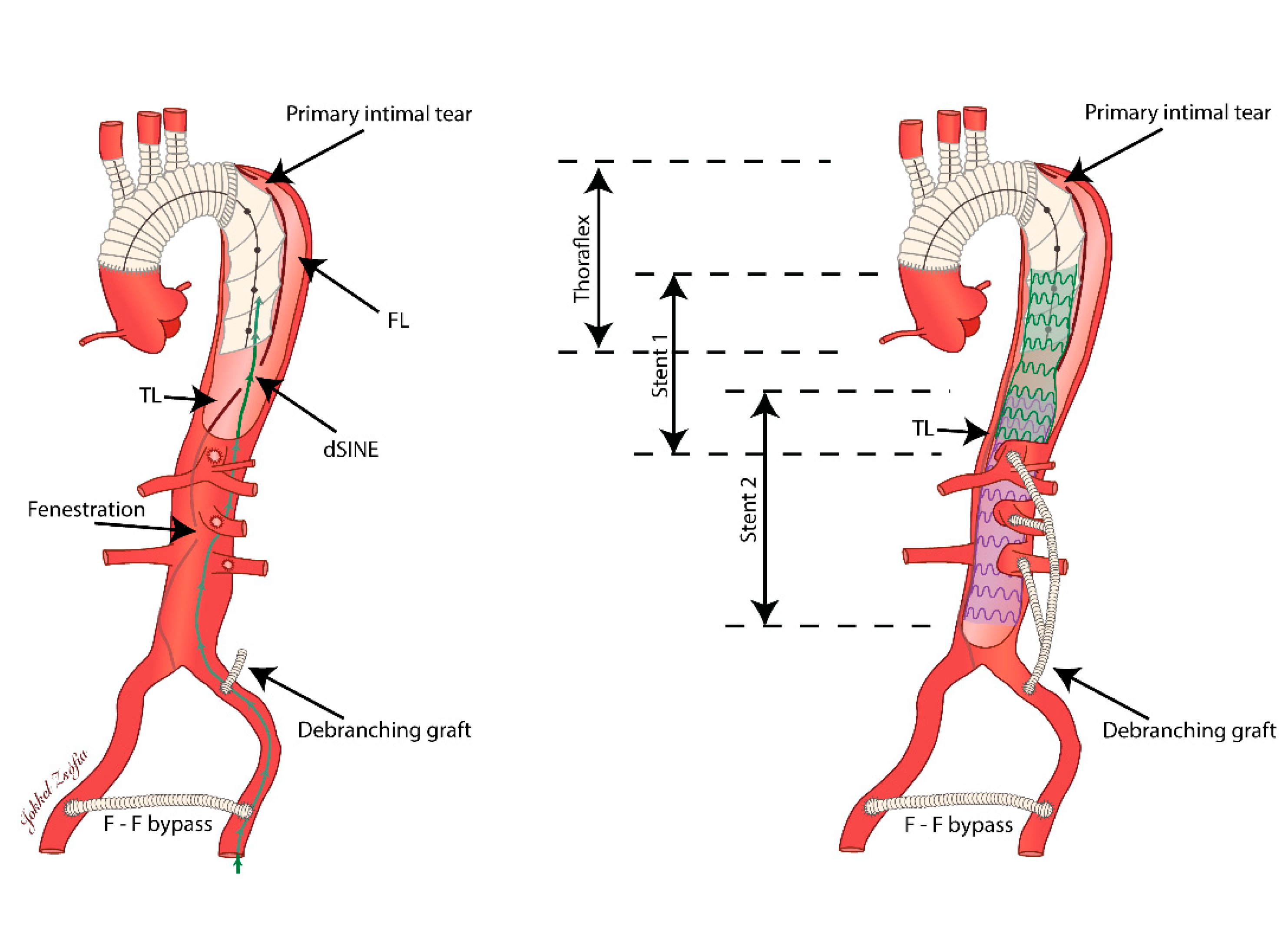 Staged Hybrid Repair Of A Complex Type B Aortic Dissection