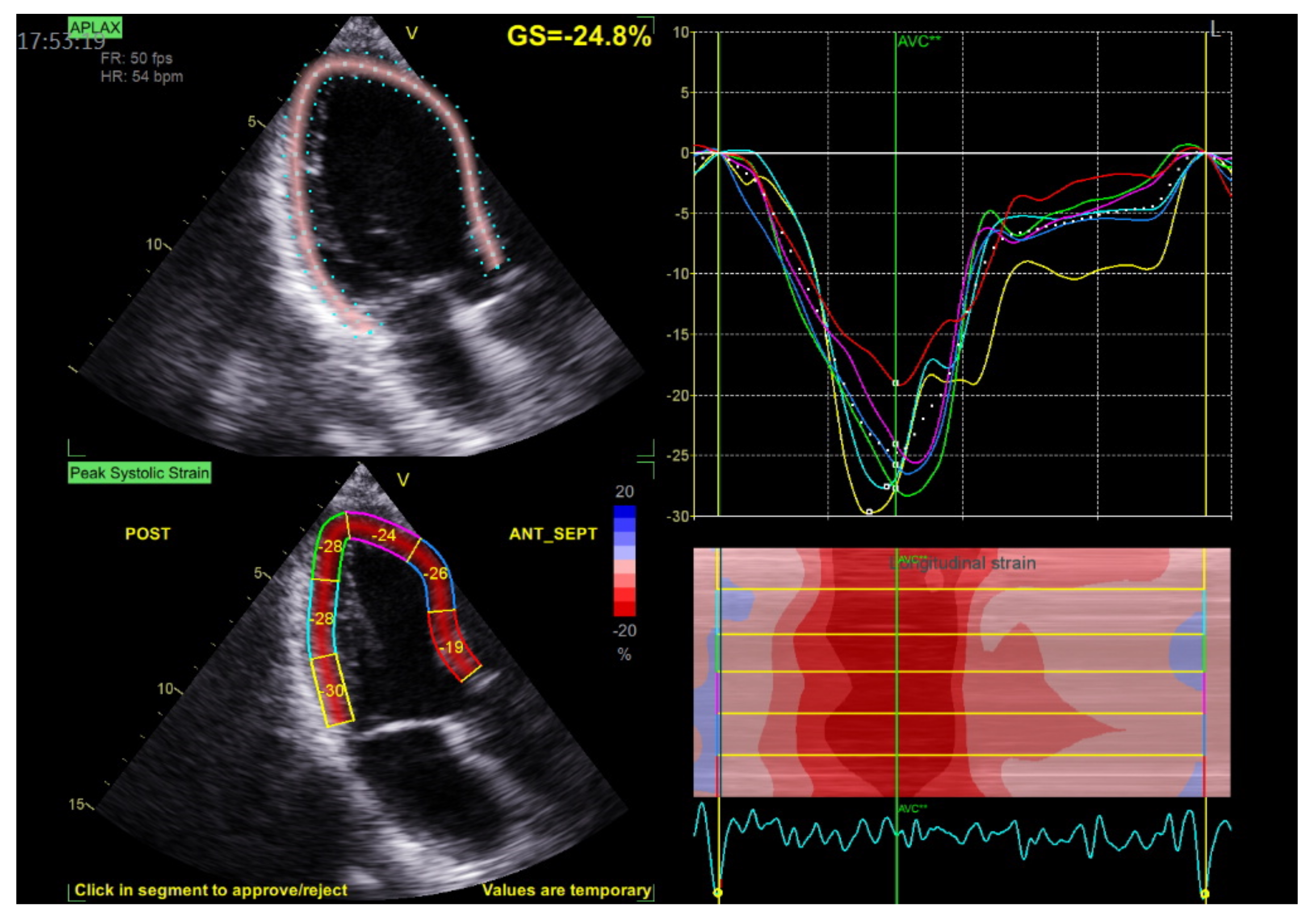 K. Papadopoulos  Left ventricular volume and global longitudinal strain  after cardiac resynchro 