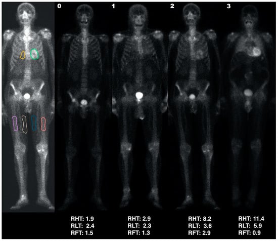 JCDD | Free Full-Text | Semi-Quantification of Myocardial Uptake of ...