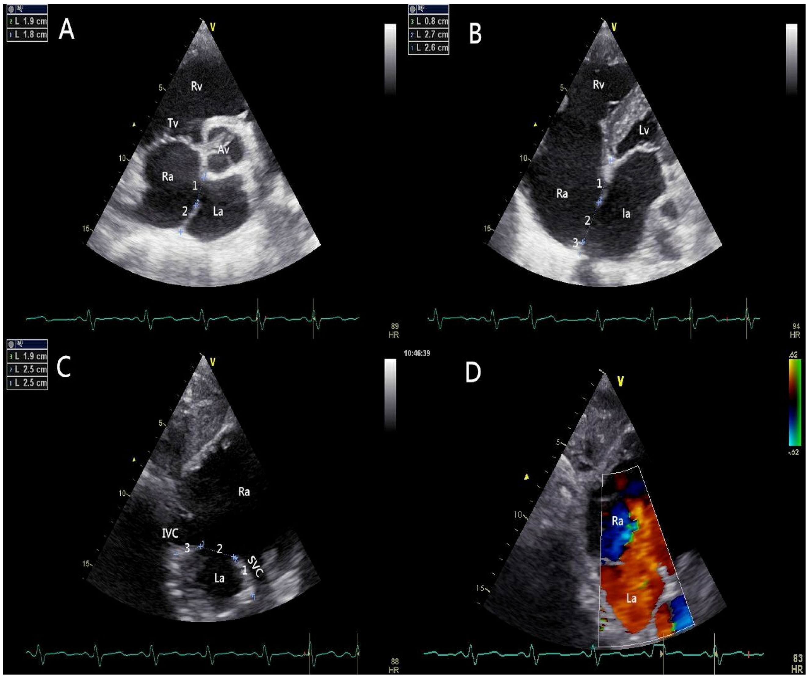 Transthoracic echocardiogram at admission and 6 mo follow up: global
