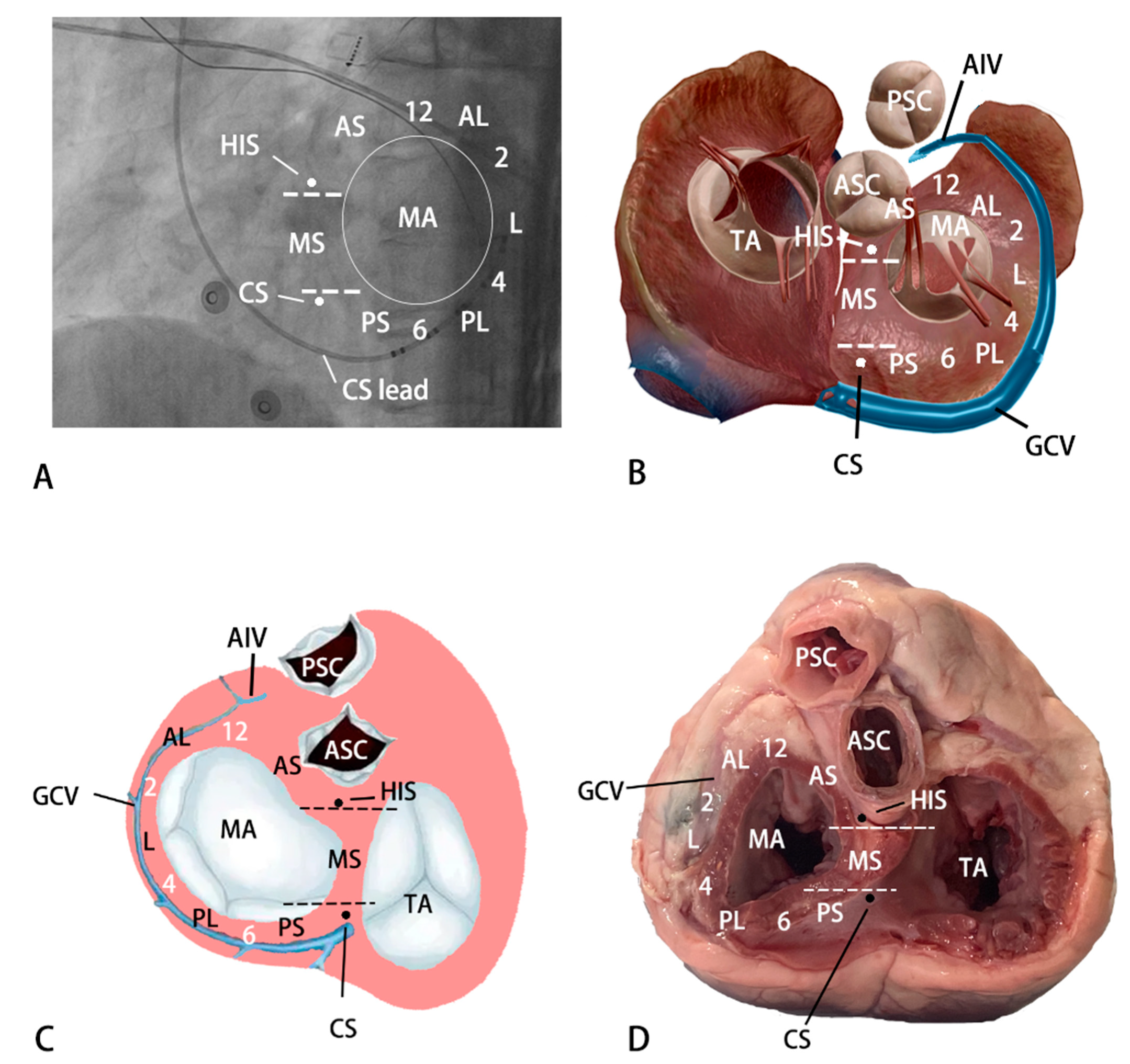 JCDD | Free Full-Text | Electrocardiographic Characteristics of