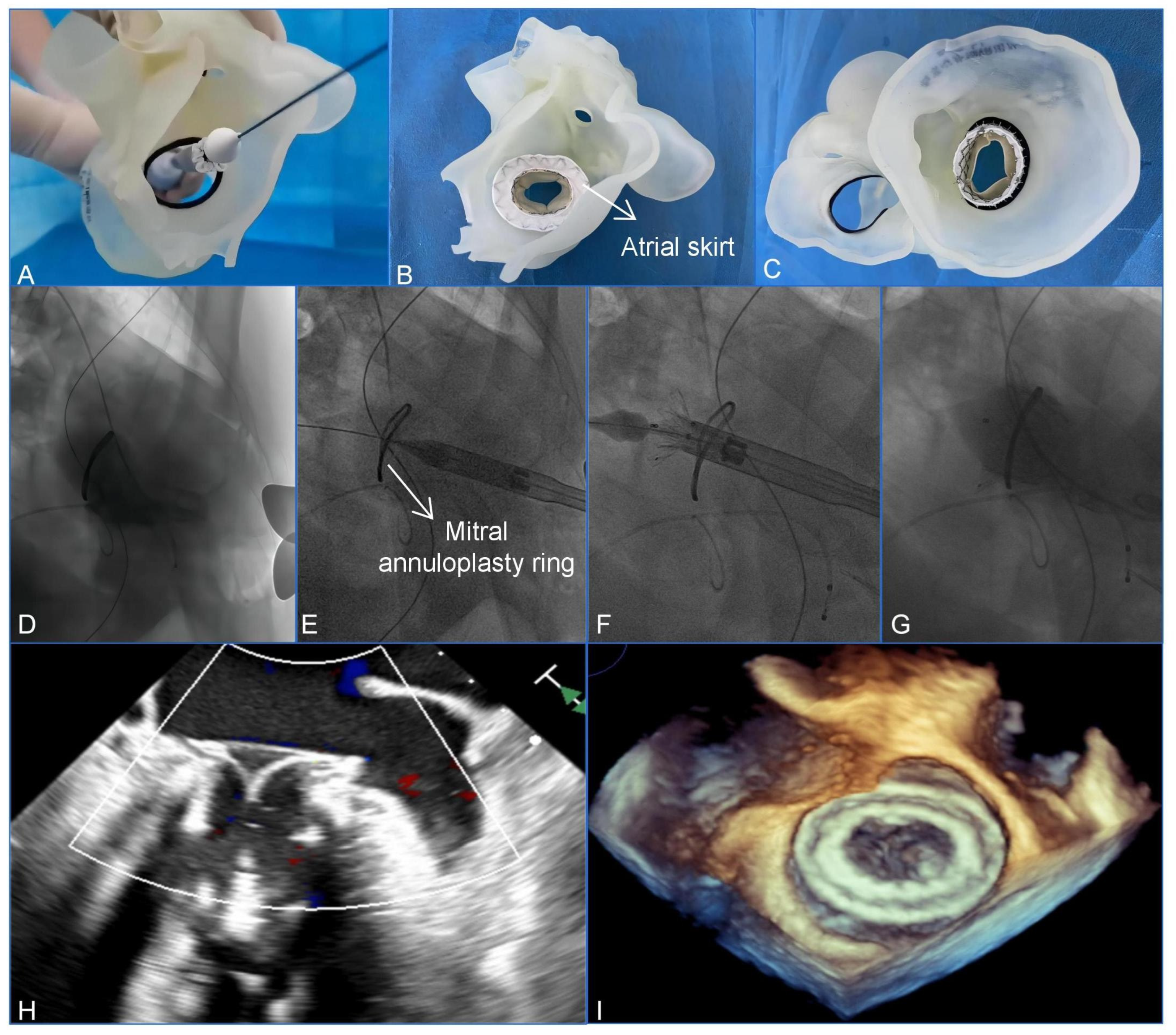 Surgical Valve Solutions | Repair Aortic & Mitral Valve