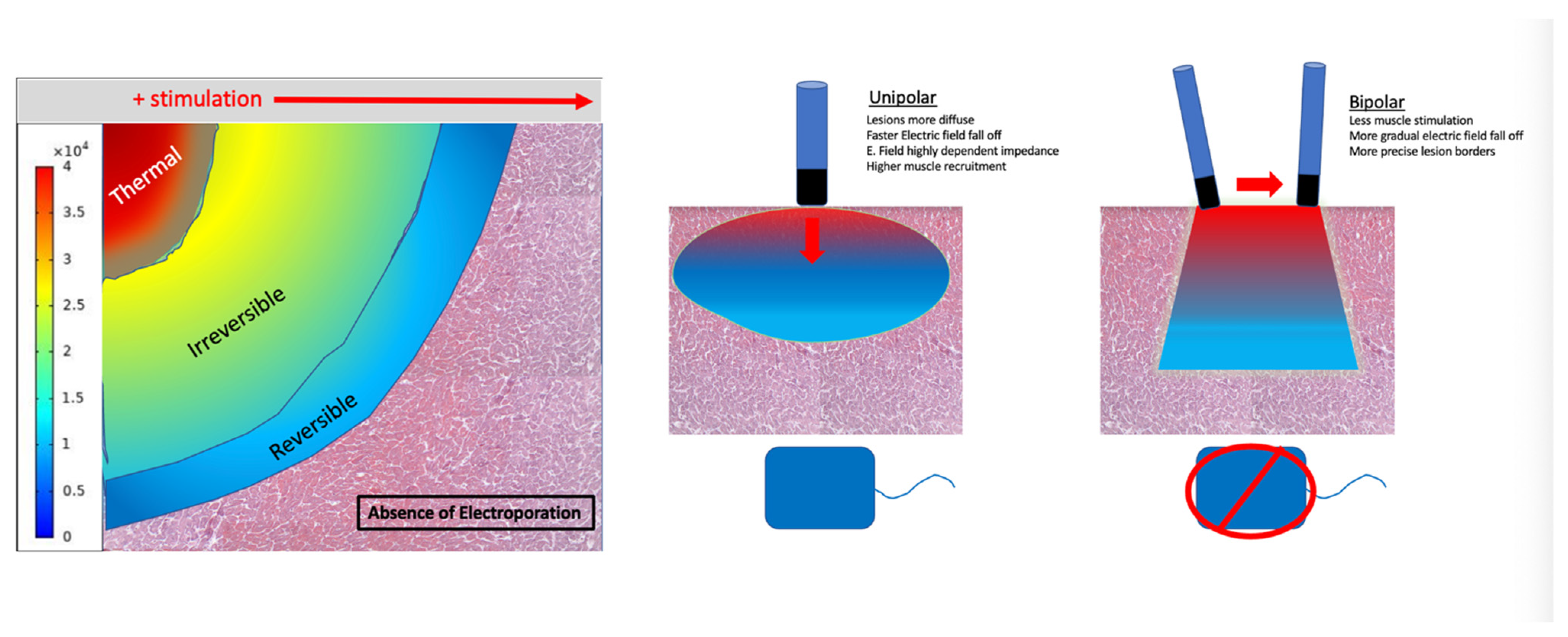 Contemporary Trends In Pulsed Field Ablation For Cardiac Arrhythmias