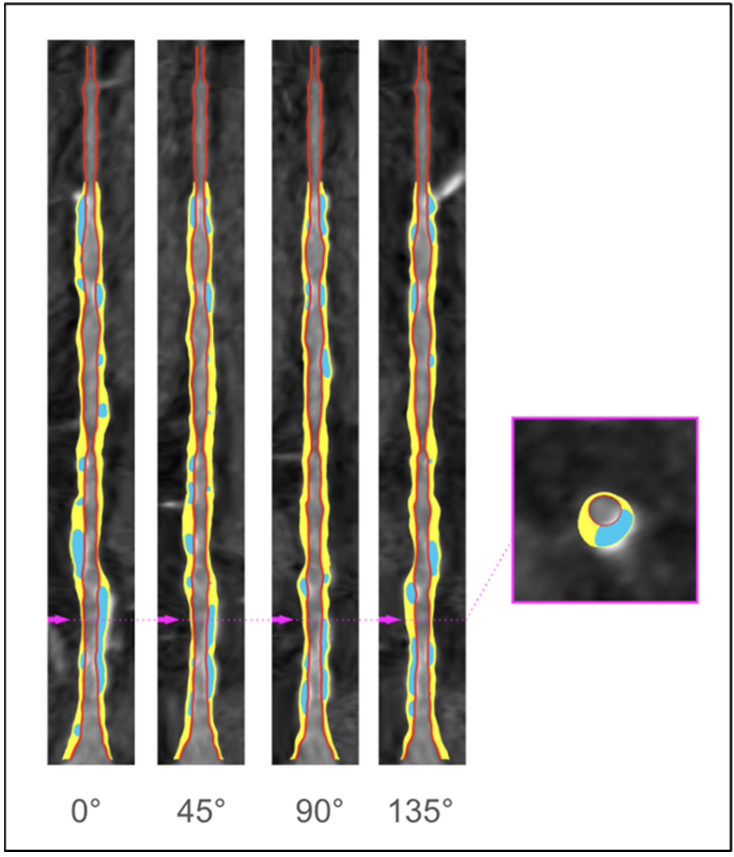 Computed Tomography Angiography in the Catheterization Laboratory: A ...