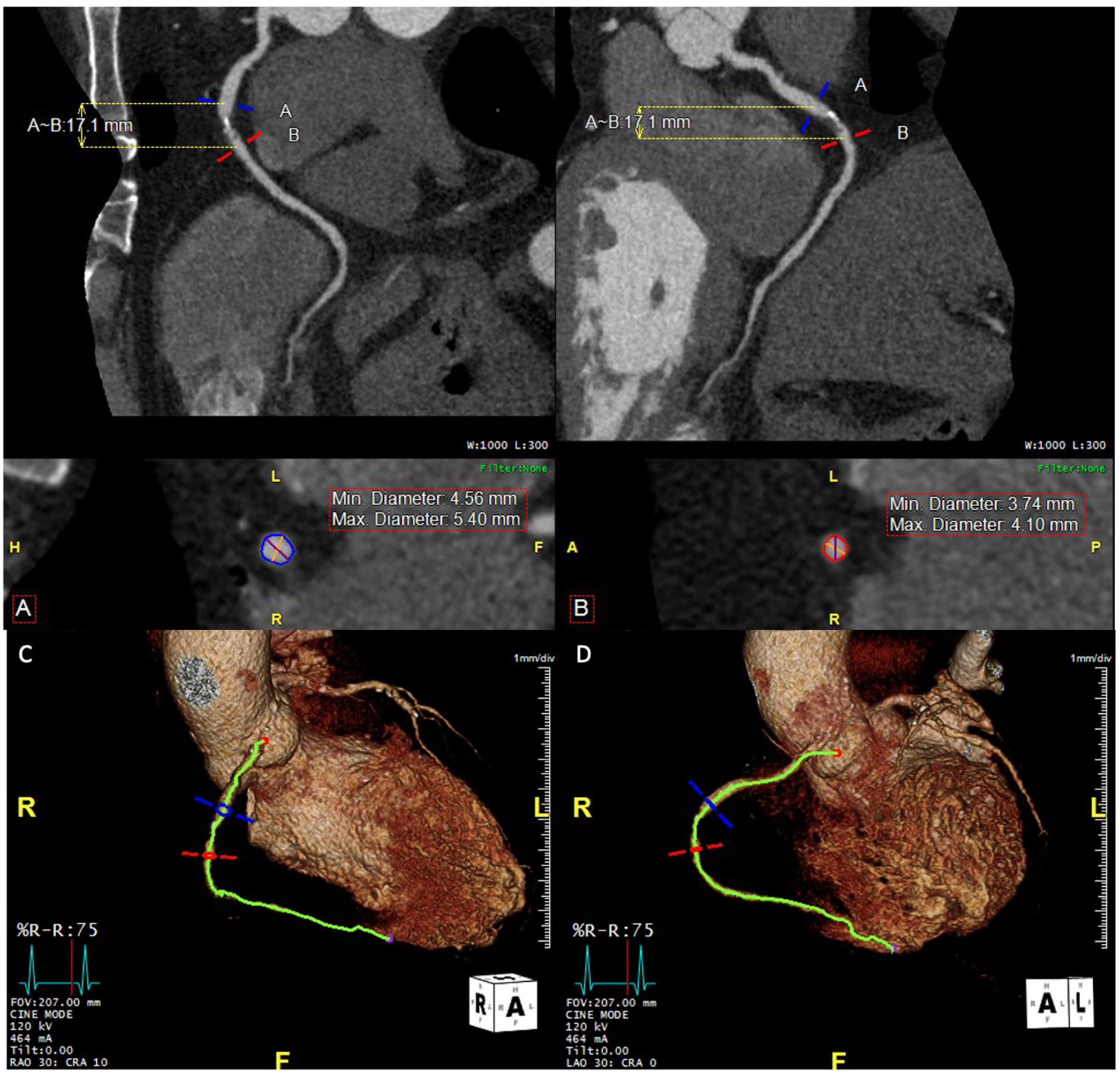 Computed Tomography Angiography in the Catheterization Laboratory: A ...