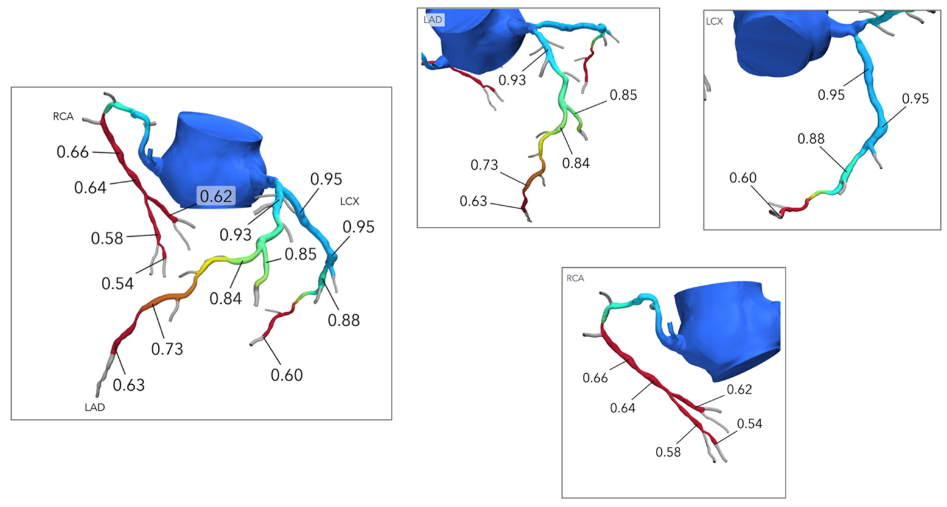 Computed Tomography Angiography in the Catheterization Laboratory: A ...