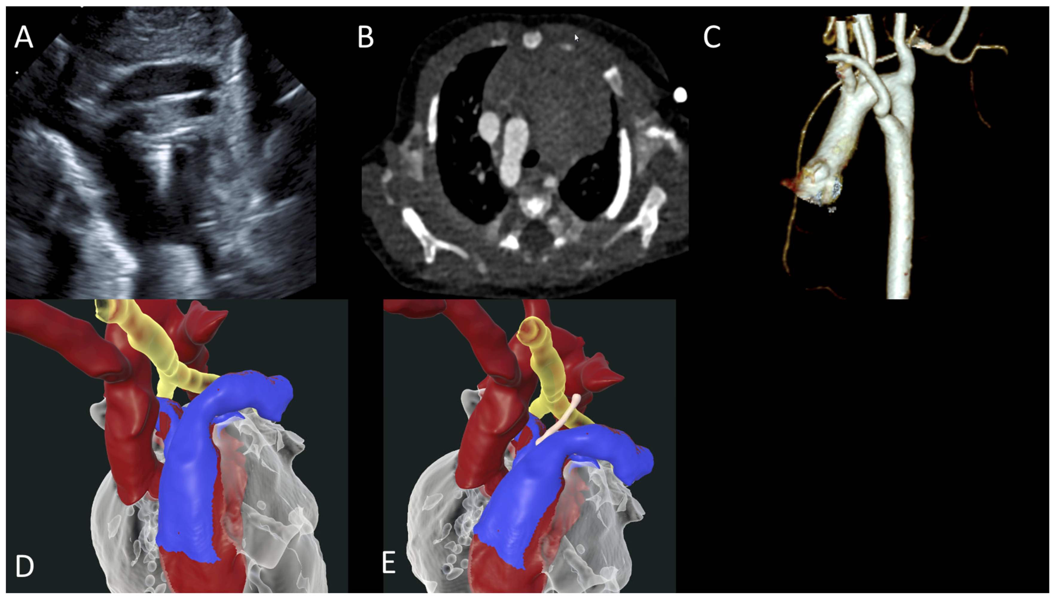 Virtual Reality to Enhance Understanding of Congenital Heart Disease