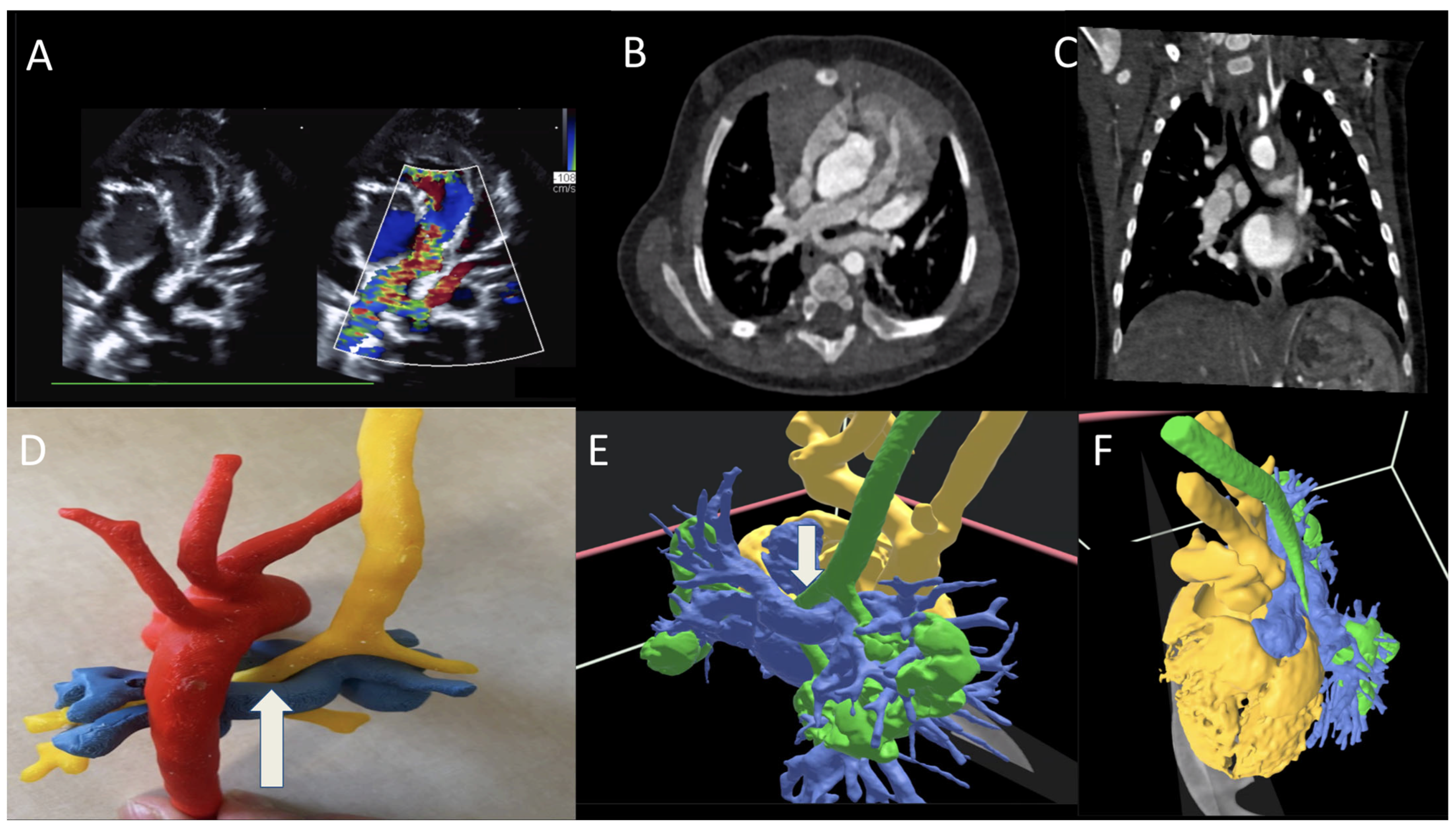 Virtual Reality to Enhance Understanding of Congenital Heart Disease