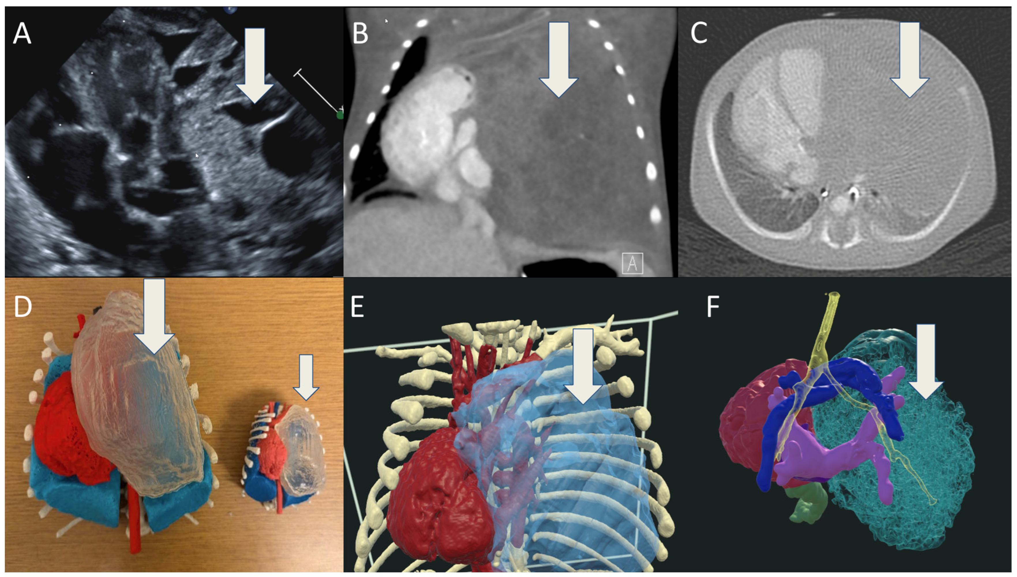 Virtual Reality to Enhance Understanding of Congenital Heart Disease