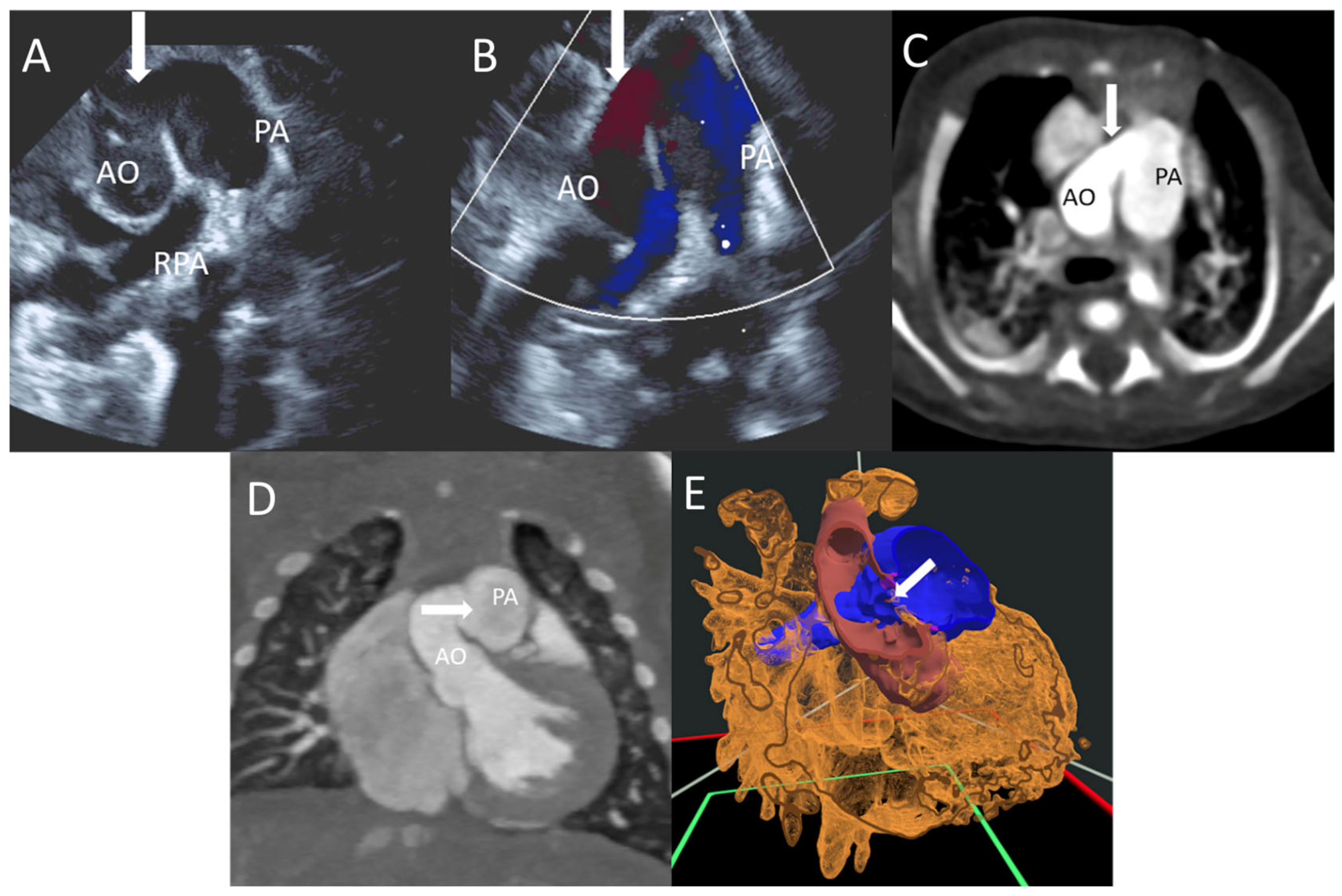 Virtual Reality to Enhance Understanding of Congenital Heart Disease