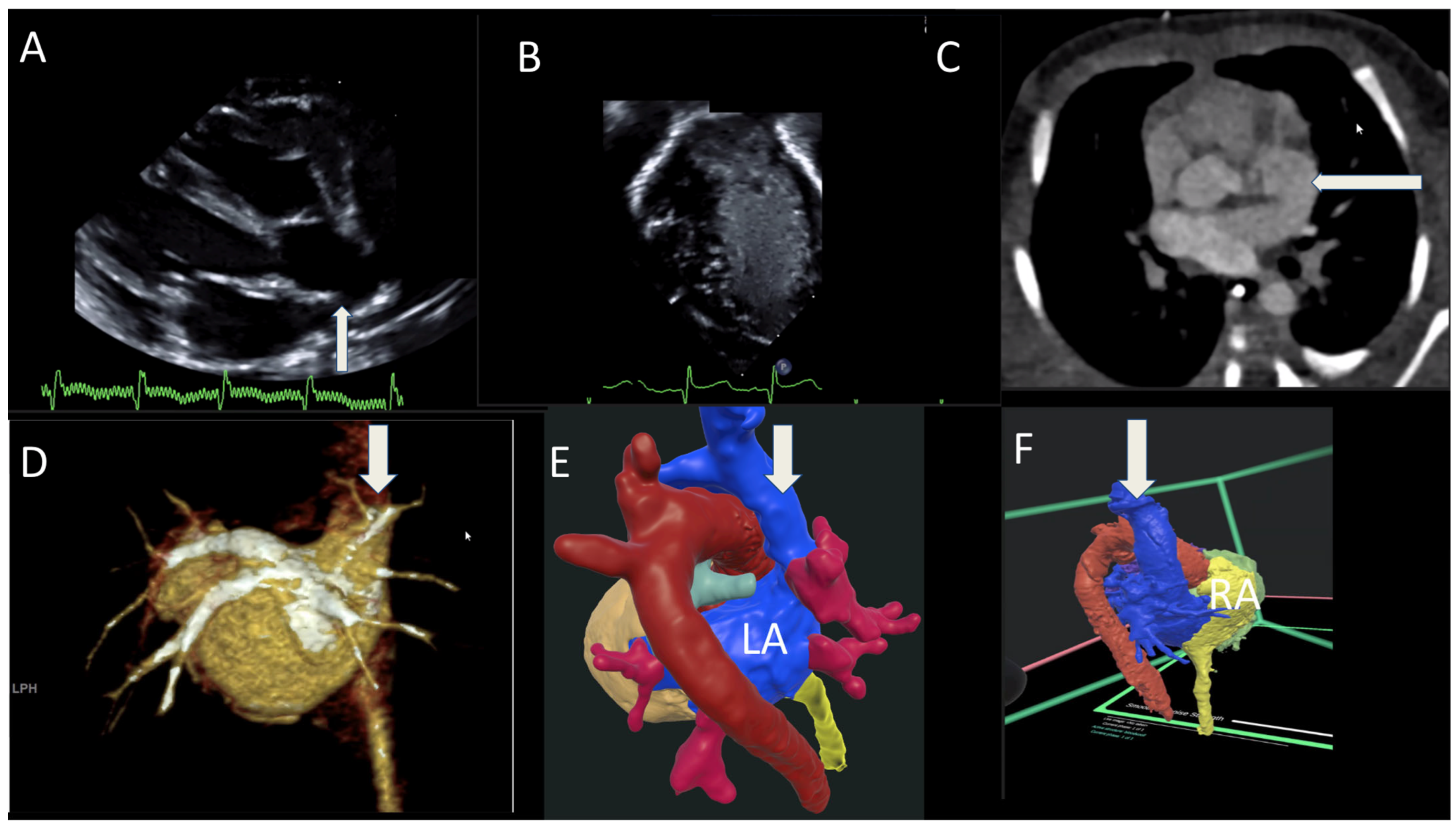 Virtual Reality to Enhance Understanding of Congenital Heart Disease