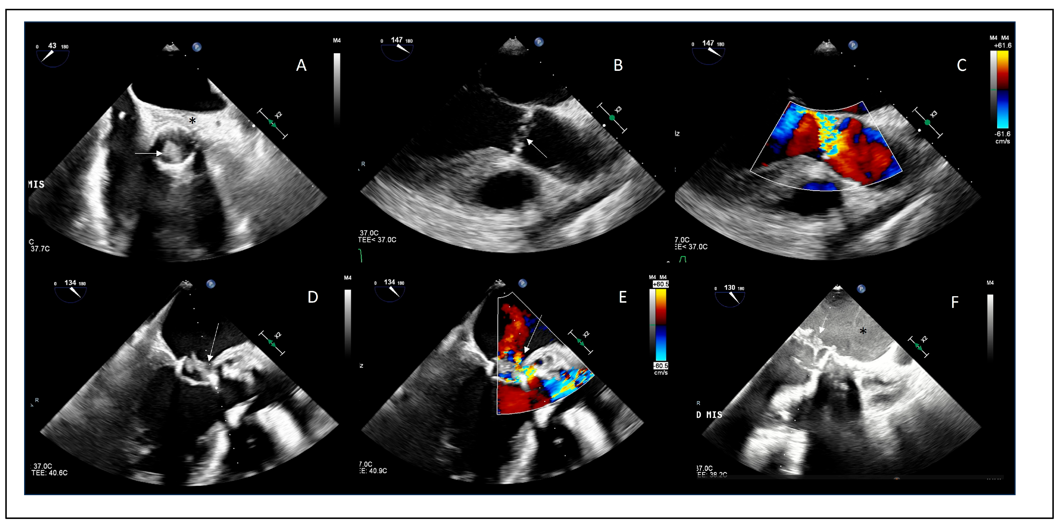 Current Management of Infective Endocarditis: A Narrative Review ...