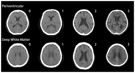 White Matter Changes in Patients with Alzheimer’s Disease and ...