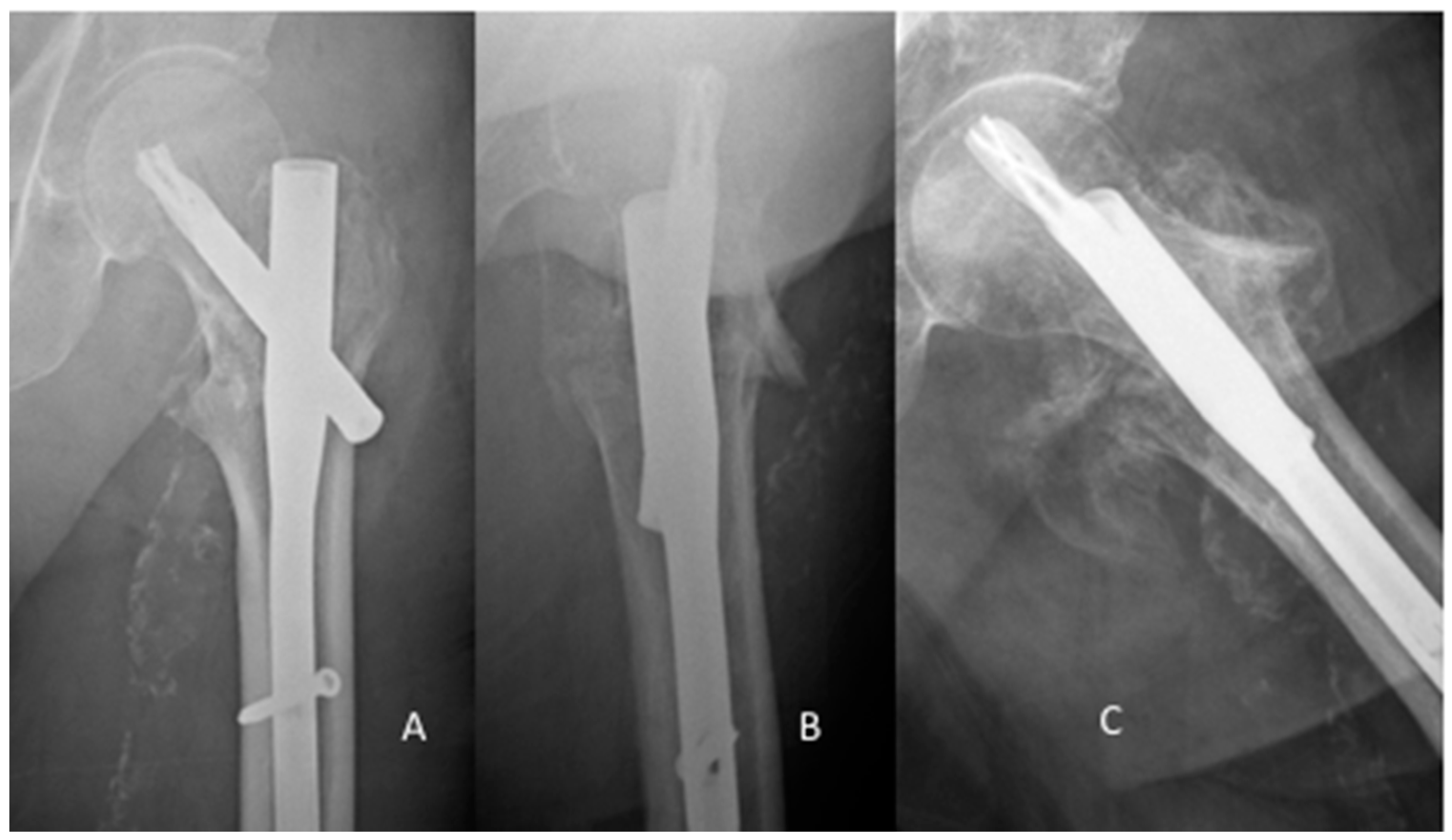 JCM | Free Full-Text | Migration of the Lag Screw after Intramedullary  Treatment of AO/OTA  Pertrochanteric Fractures Does Not Result in  Higher Incidence of Cut-Outs, Regardless of Which Implant Was Used: