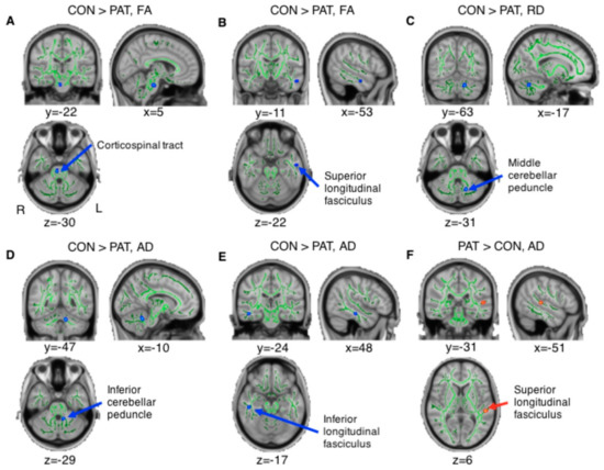 JCM | Free Full-Text | Altered White Matter Integrity after Mild to