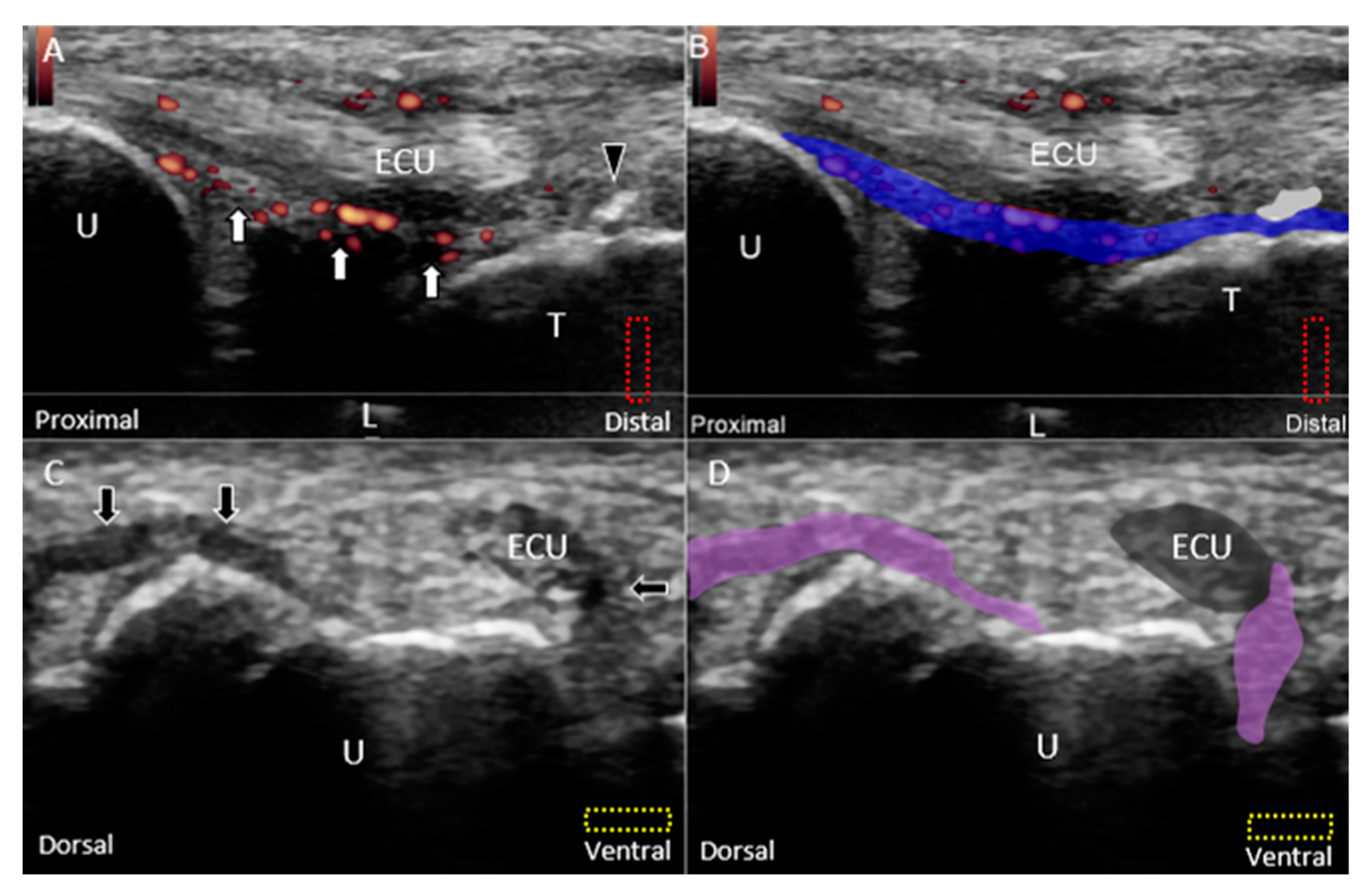 ulnar collateral ligament thumb ultrasound
