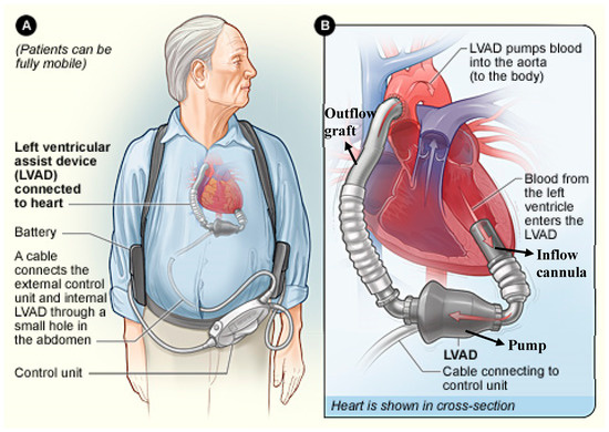 LVAD Bags: Home