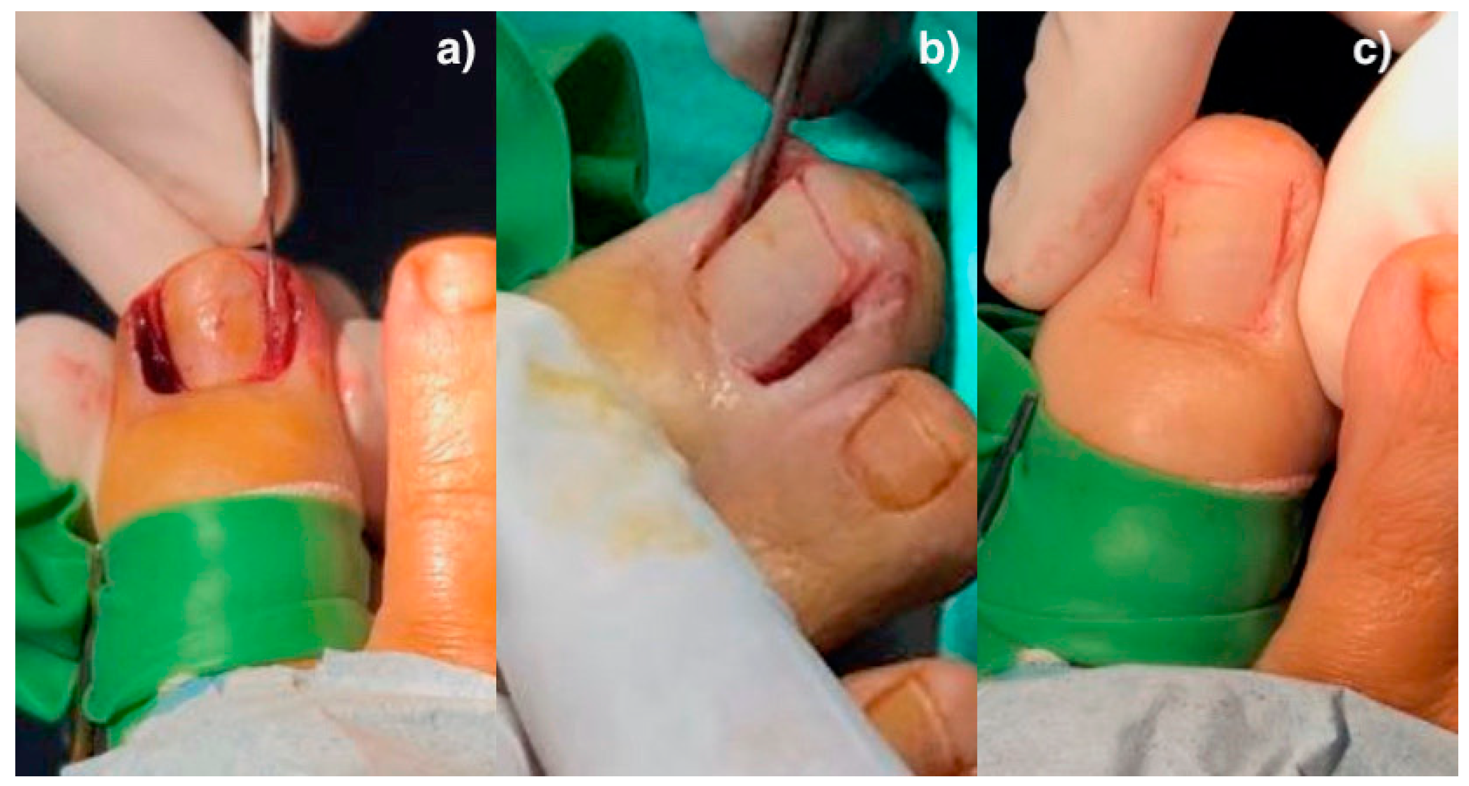 Ingrown Nails: Background, Pathophysiology, Etiology