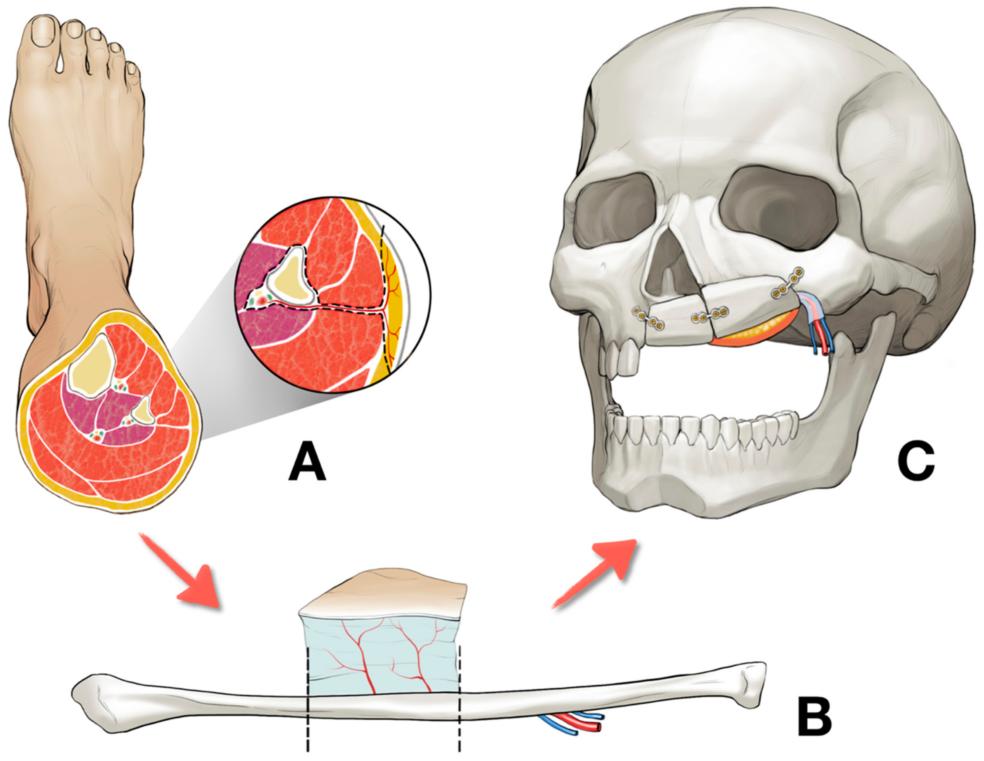 Delayed Reconstruction Of Palatomaxillary Defect Using Fibula Free Flap Delayed Reconstruction Of Palatomaxillary Defect Using Fibula Free Flap
